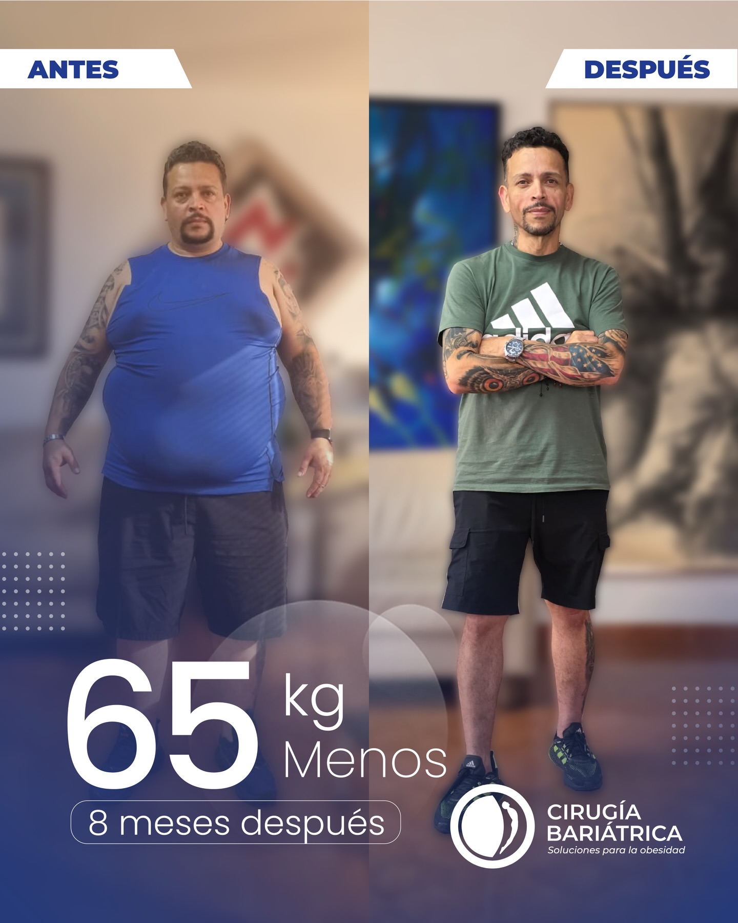 65 kilos menos en 8 meses… un cambio que trasciende lo físico 🙌🔥
Gracias a la cirugía bariátrica realizada por el Dr. Eduardo Bolaños y su equipo, hoy este paciente inicia una nueva etapa, con más vitalidad y una mejor calidad de vida 💪✨
Con el respaldo de tecnología de vanguardia, experiencia médica y un acompañamiento integral, los resultados evidencian una transformación real y duradera ✅🏆
📍Agenda tu valoración y empieza hoy el camino hacia tu mejor versión.
#bariatric #bariatricsurgery #bajardepeso #weightlosssurgery #cirugiabariatrica