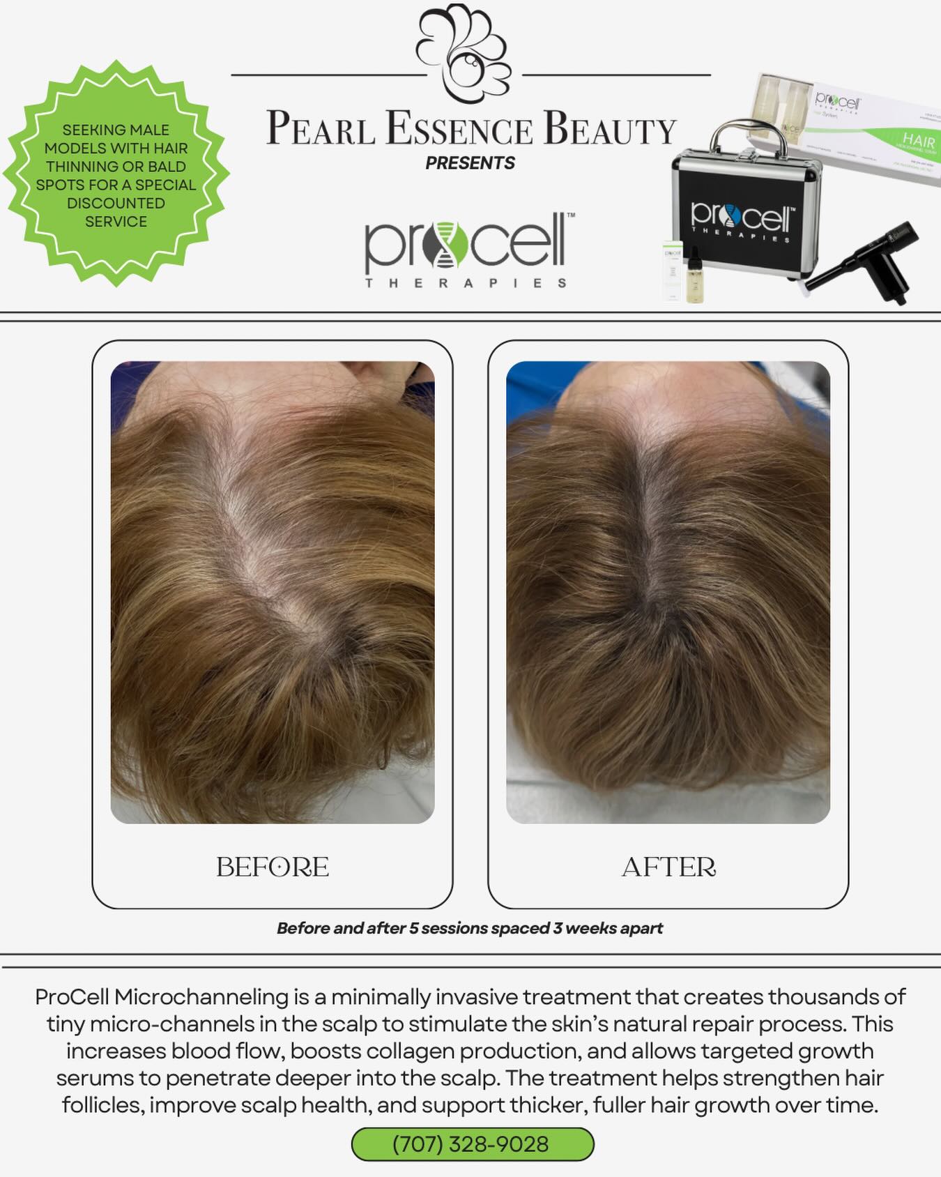 Struggling with thinning hair or bald spots? ✨
Our ProCell Microchanneling treatment stimulates your scalp for stronger, fuller looking hair over time.
Now booking male models for a limited discounted service
Real results. Real growth.
📩 DM to be a model & save on your sessions.