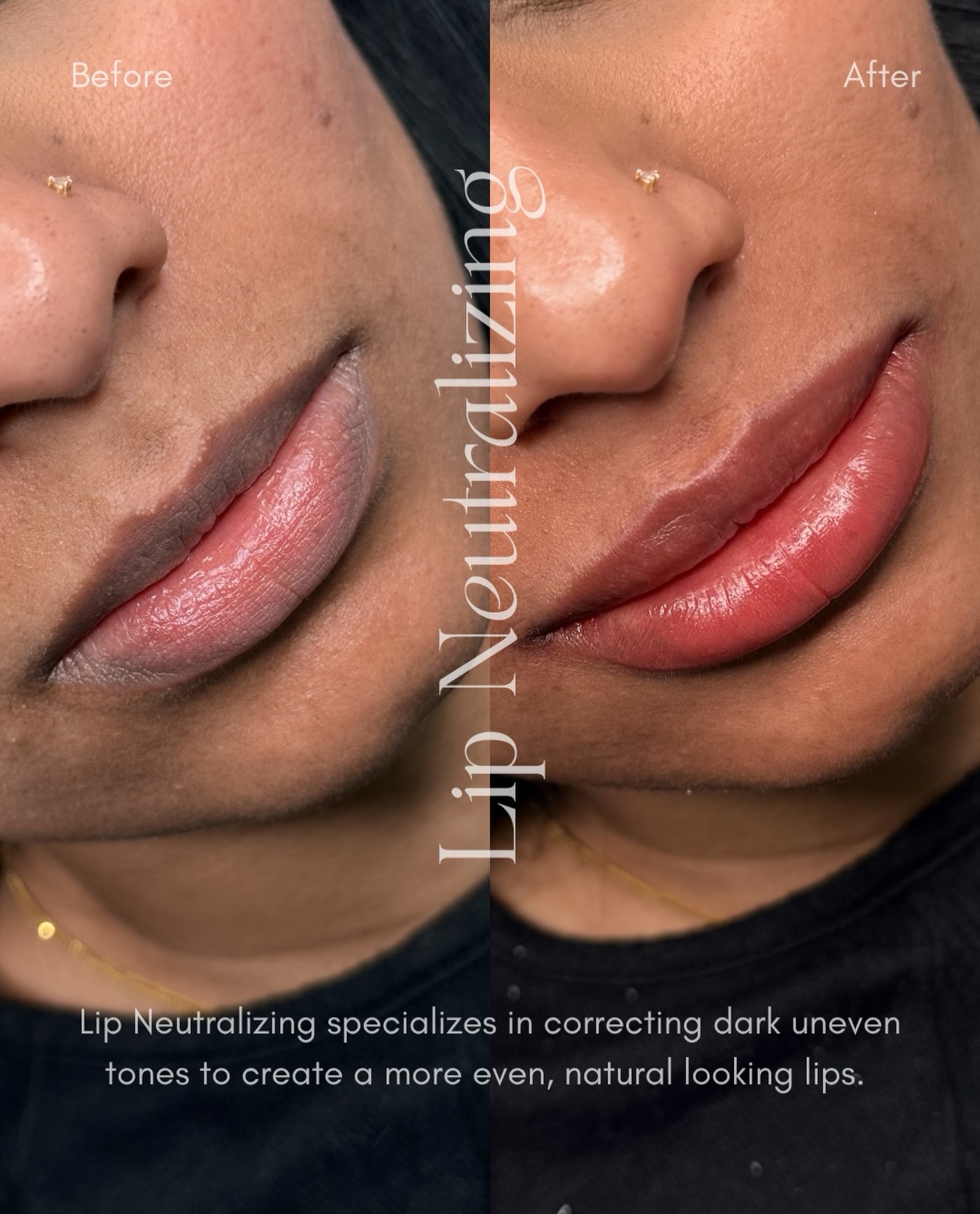 The best feeling is being able to make someone feel the most confident in their own skin.
#lipneutralization #lipneutralizing #toronto #torontobeauty