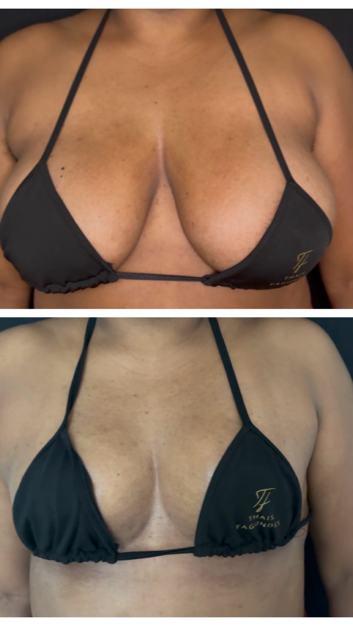 Mais um lindo caso de mamoplastia com cicatriz em L
2 meses de cirurgia
E como estamos 🤩