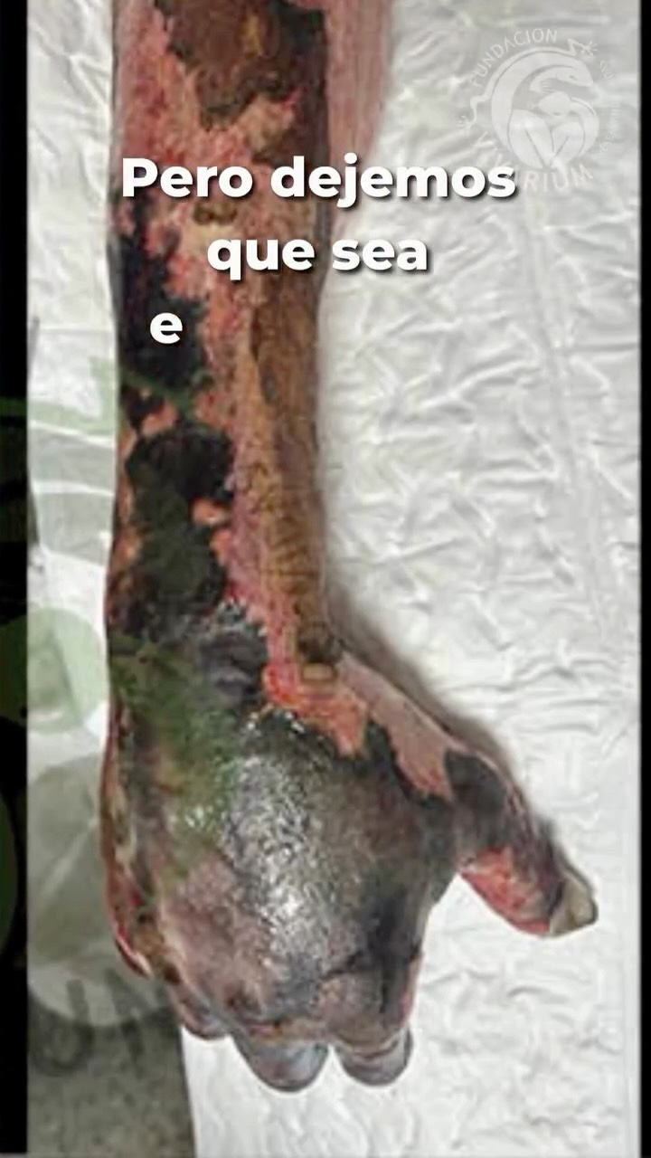 🐍 ESTE CASO ES REAL. Y PUDO SER DIFERENTE.
(Actualización del caso del Sr. Carlos de Portuguesa)
El Sr. Carlos fue mordido por una serpiente del género Bothrops.
Con el paso de las horas, el cuadro se agravó.
El resultado fue la amputación de su mano.
Hoy, su estado sigue siendo delicado debido a una infección por bacteria resistente. Actualmente necesita tratamiento con antibióticos de uso hospitalario como Colistina y Tigeciclina.
Este caso nos recuerda algo clave:
el tiempo puede marcar la diferencia entre conservar una vida… o perder parte de ella.
🎯 HOY NECESITA APOYO
El tratamiento continúa y los costos son elevados.
Si deseas ayudar, puedes hacerlo a través de:
📌 Pago Móvil – Bancamiga
J-502156399
0424-4085311
📌 Cuenta Corriente
0172-0201-49-2015105170
Tu apoyo suma.
Compartir también ayuda.
#AccidenteOfidico #Prevencion #SaludComunitaria #FundacionVivarium #Apoyo EmergenciaMedica Venezuela