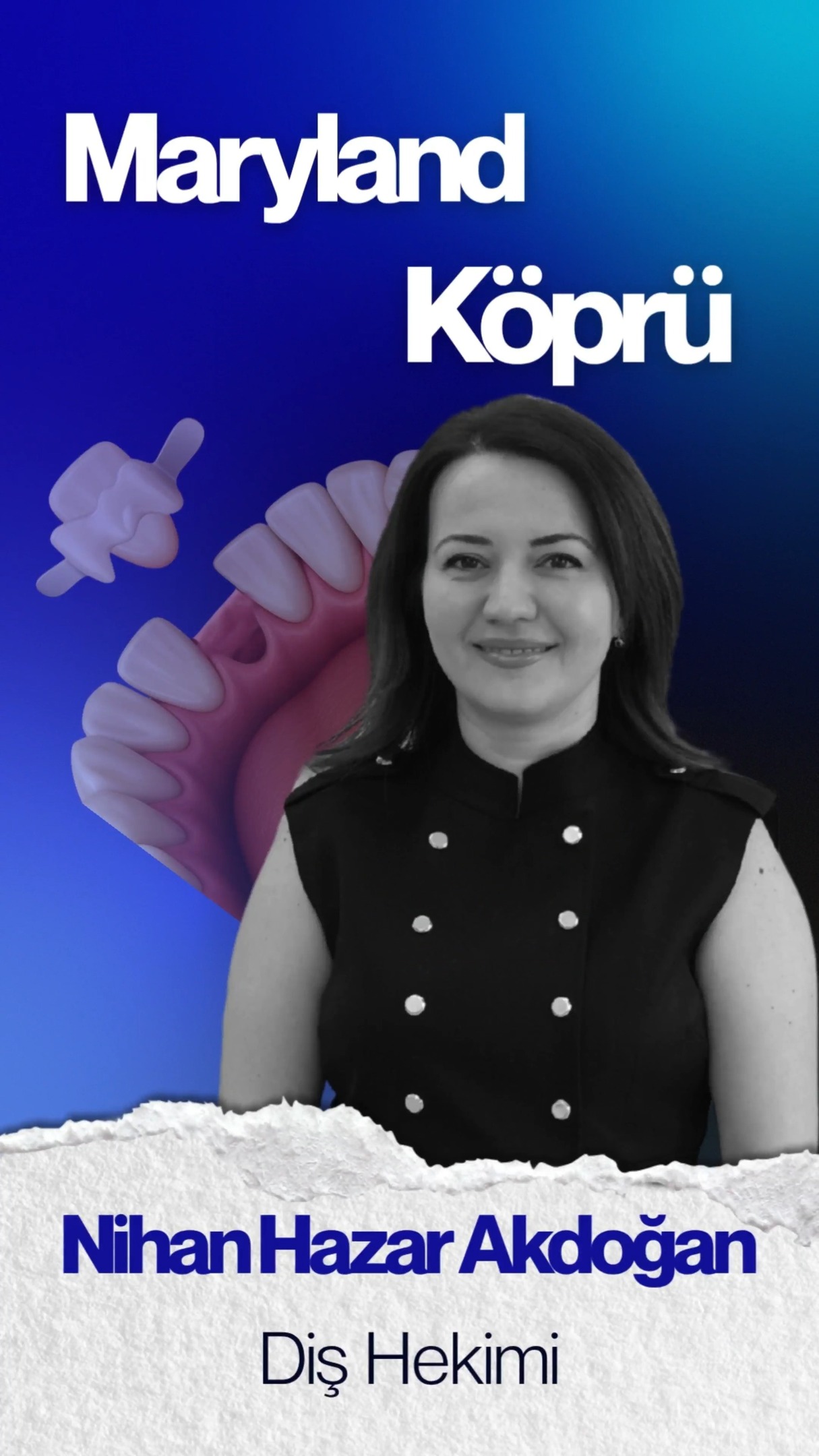 Tek diş eksikliği, estetik ve fonksiyon açısından günlük yaşamı etkileyebilir. İmplant tedavisi düşünmeyen ya da komşu dişlerin kesilmesini istemeyen bireyler için, uygun vakalarda alternatif tedavi seçenekleri değerlendirilebilir.
Maryland köprü, komşu dişlerin arka yüzeyine özel bağlantılarla desteklenerek uygulanan, minimal müdahale gerektiren bir sabit protez yöntemidir. Kullanılan materyale ve hastanın ağız yapısına bağlı olarak estetik ve doğal bir görünüm hedeflenir.
🦷 Kayaşehir Ağız ve Diş Sağlığı Polikliniği
👩⚕️ Dr. Nihan Hazar Akdoğan
Detaylı bilgi ve size uygun tedavi seçeneklerinin değerlendirilmesi için muayene gereklidir. #marylandköprü #dişeksikliği #estetikdişhekimliği #protetikdiştedavisi #kayasehirdisklinigi #istanbuldishekimi #disestetigi #gulumsetasarimi