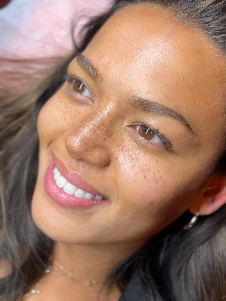 Swipe voor de healed frecksss 🫶🏼🔀
Deze sproetjes hebben we in 2 sessies gecreëerd: de eerste laag was op basis van een zachte kleur. Tijdens de touch-up gingen we voor een krachtige tint: zo was de wens een neuscontouring en zachte verspreiding naar de wangen.
Een donkere kleur = langere wachttijd voor een zacht resultaat. Máár, het wachten is het helemaal waard🚀
#freckles #healedpmu #sproetjes #pmufreckles