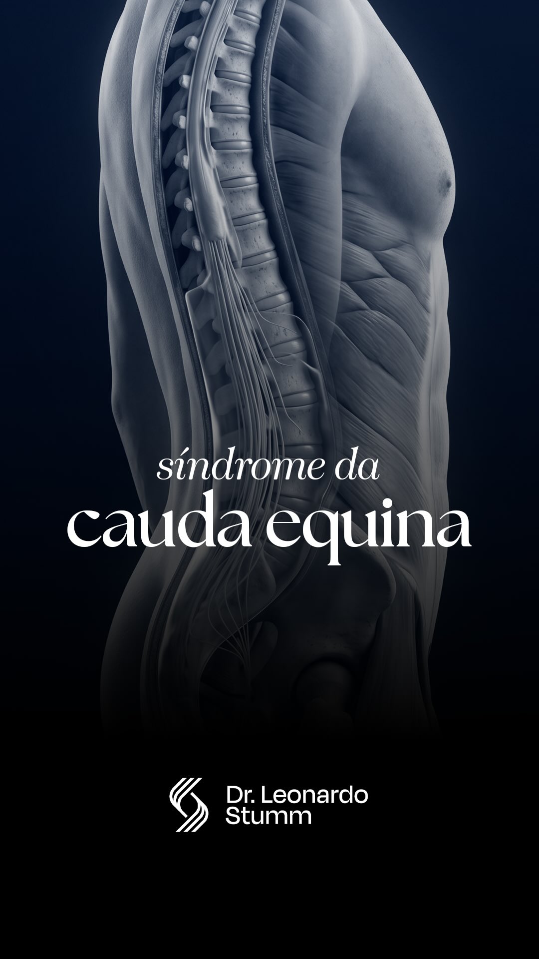 A maioria das pessoas associa hérnia de disco apenas à dor lombar ou à dor ciática.
Mas existe um ponto importante: em situações raras, uma hérnia pode provocar uma compressão neurológica grave chamada síndrome da cauda equina — e aí o quadro deixa de ser apenas doloroso para se tornar uma urgência médica.
O problema é que muitos pacientes não imaginam que alterações urinárias, perda de sensibilidade na região íntima ou dificuldade para controlar a urina podem ter relação direta com a coluna.
E isso acaba atrasando a procura por atendimento.
Na prática, o que costuma confundir é que a dor muitas vezes já existia antes. O paciente pensa: “é só mais uma crise”. Só que alguns sintomas mudam completamente a gravidade do caso.
Quando há compressão importante das raízes nervosas da cauda equina, o tratamento cirúrgico precisa ser rápido para reduzir o risco de sequelas neurológicas permanentes.
Esse é o tipo de informação que pode evitar consequências sérias quando reconhecida a tempo.
#ortopedia #colunavertebral #dor #medicina #cirurgiadacoluna