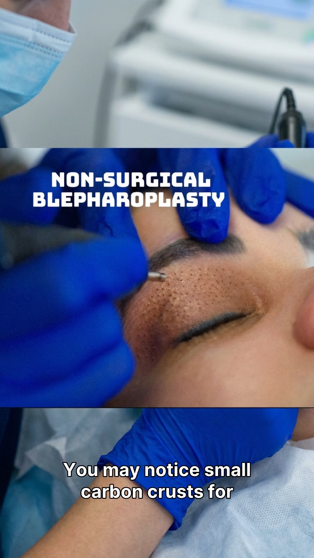✨ Rejuvenate your eyes without surgery ✨
Experience the precision of Plasma Pen Eye Rejuvenation — tightening and lifting the delicate eyelid area for a smoother, more youthful look.
Expect 4 days of swelling, scabs that fall off in about 7, and results that speak for themselves.
📲 Text 212‑920‑7363 for your consultation.
💎 Beauty by Stefany – Midtown NYC
#PlasmaPen #EyeRejuvenation #BeautyByStefany #LuxurySkincare