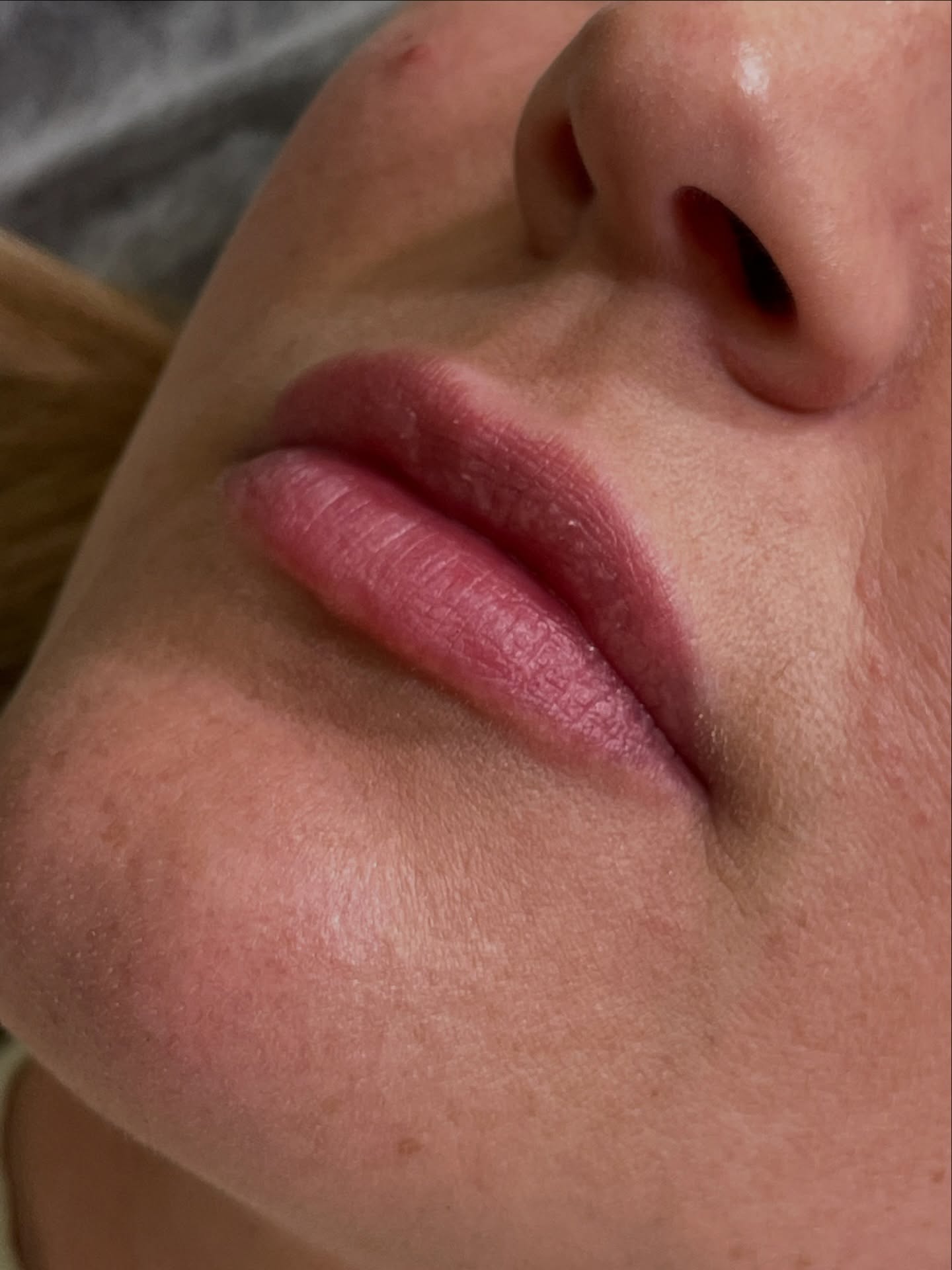 Tilhelede lepper etter filler 👄 Vi elsker naturlige resultater, og fremheve dine beste trekk på en god måte. Filler vil ikke bare gi volumøkning og definisjon - men tilfører også fuktighet og bedrer sirkulasjon. Vi elsker å kombinere med Fotona LipLase etter noen uker 💕
Du kan få leppefiller både hos @hege_skinsation og @aurora_skinsation - og individuell konsultasjon utføres grundig i forkant, før vi sammen skreddersyr en plan for deg 😊
Nb! 20 års aldersgrense. På konsultasjon vil vi gå gjennom dine helseopplysninger og informere grundig om potensielle bivirkninger som vil eller kan oppstå.