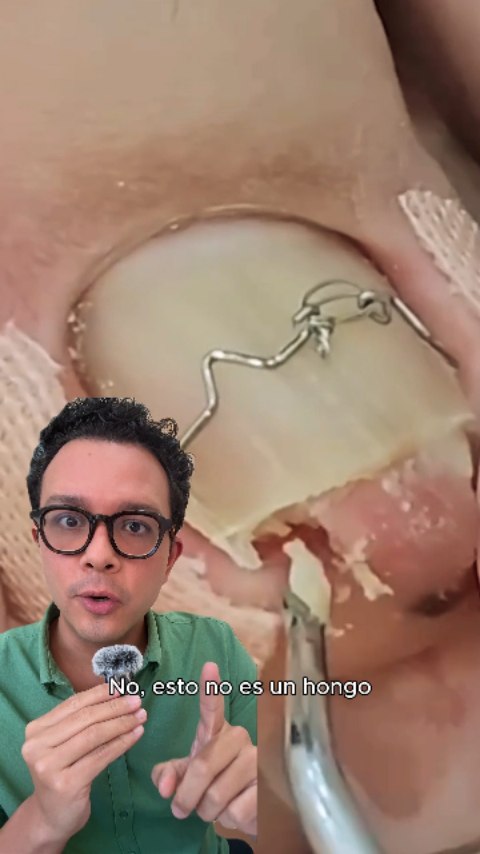 La llamada “uña en pinza” es una alteración en la forma de la uña, caracterizada por una curvatura aumentada. Puede generar presión en los tejidos y causar dolor.
🩺 La valoración es importante para definir el manejo correcto.
#UñaEnPinza #Dermatología #SaludDeLasUñas #Dermatólogo