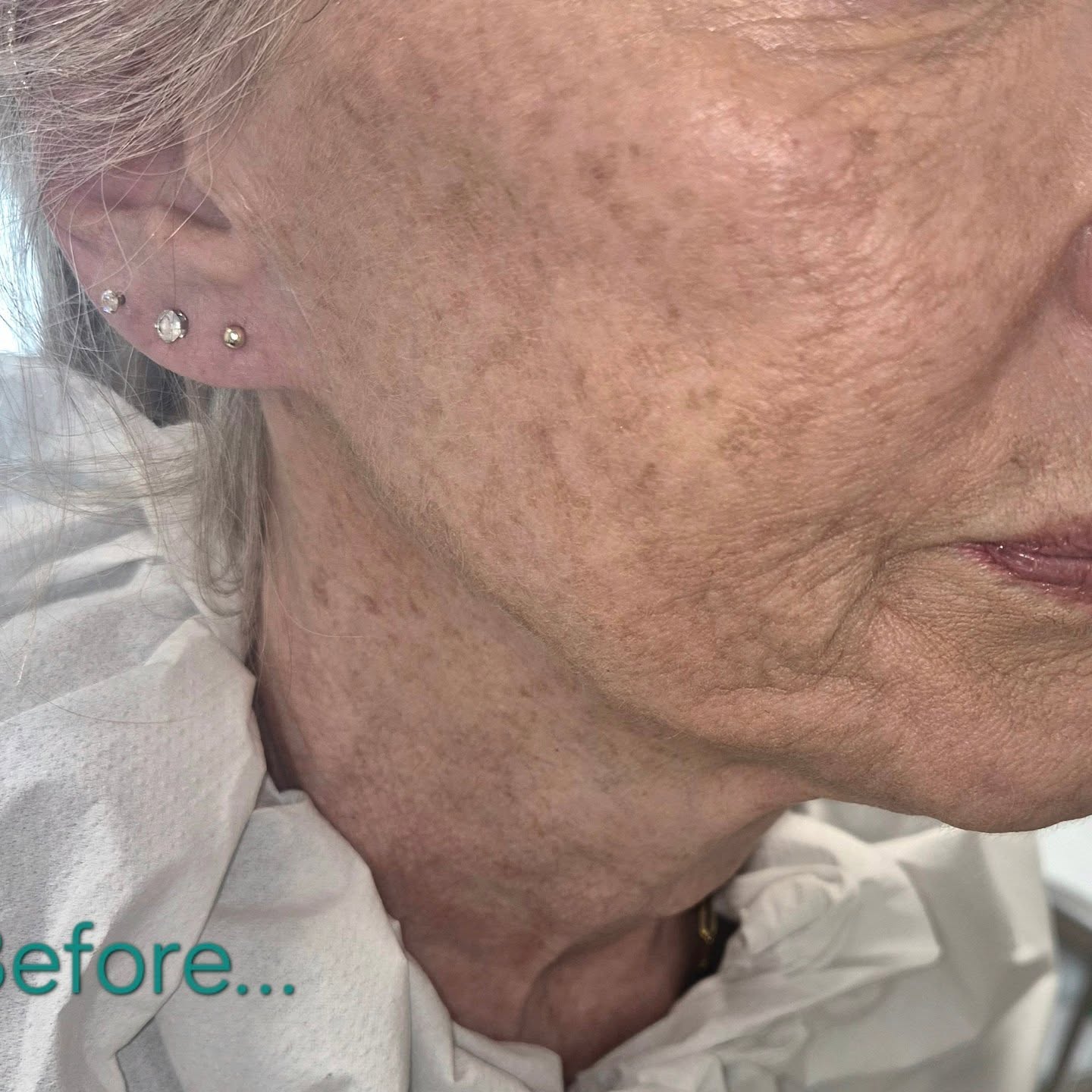 💫"I keep looking in the mirror, im absoloutely thrilled"💫
This gorgeous transformation was all about lifting and contouring in the most strategic way — using cog threads to elevate the jowls and cheek filler to enhance structure and support 💉
NO dermal filler was placed in the jawline, yet look at that definition… that sharp, sculpted finish speaks for itself 👏
The result? A lifted, contoured, ultra-glam profile — and one very happy, glowing client 💫
#cogthreadtransformation #cheekfiller #jowllift #kent #facelift
