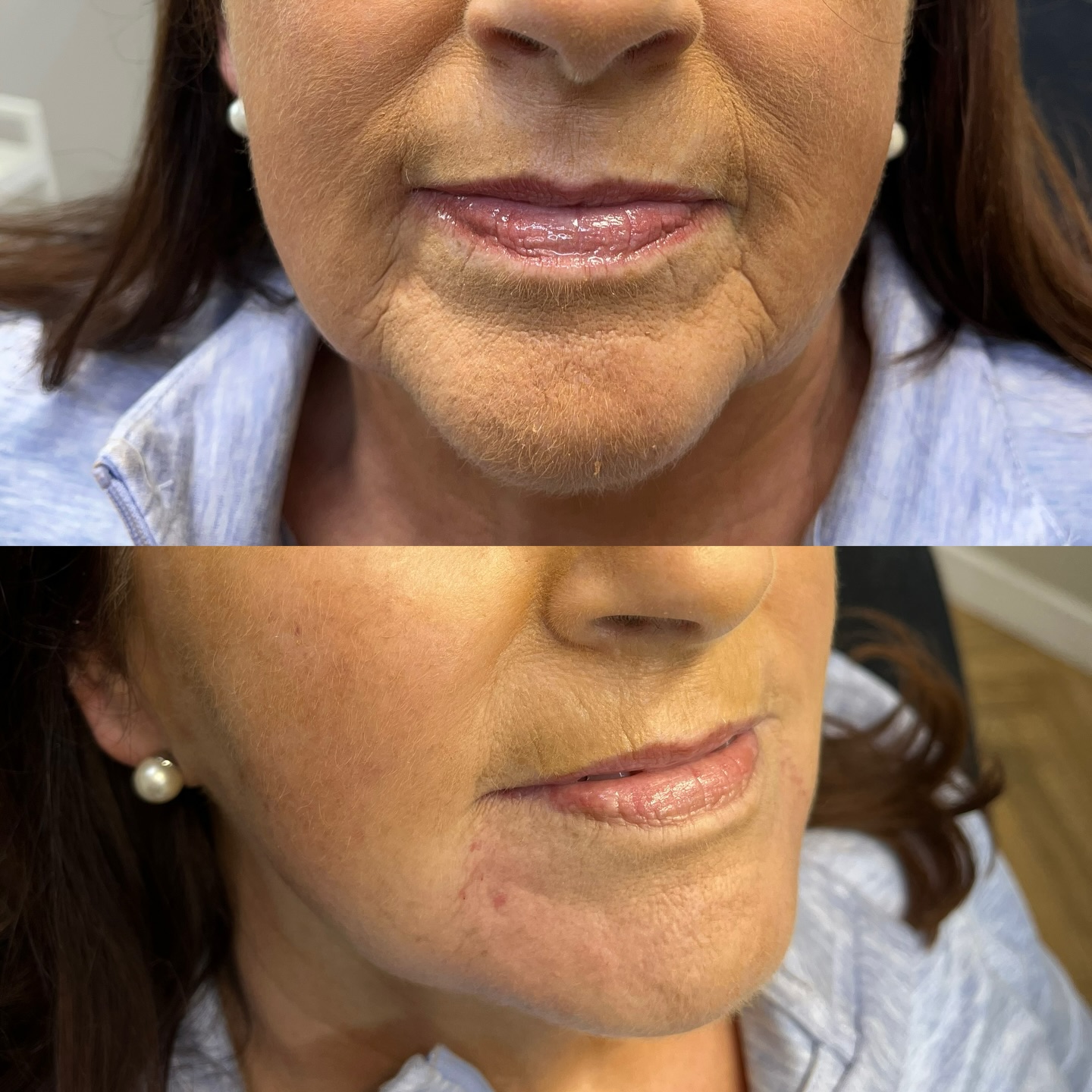 Just another job is done .
Half face -from € 490 #skinboster #dermalfillers #skinrejuvenation