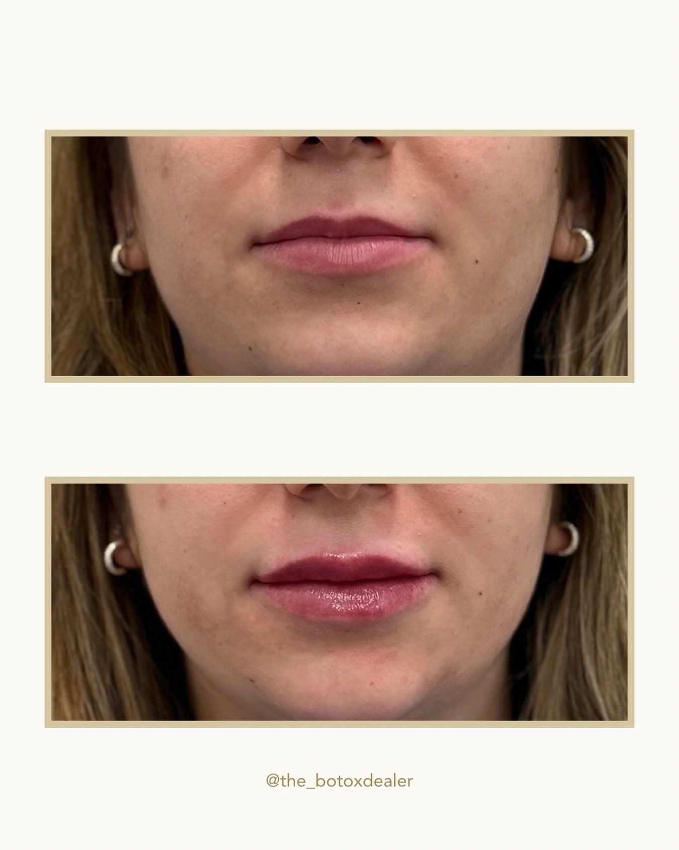 When it comes to confidence, you deserve all of it. That’s where I come in—on a mission to help you feel like your best self! Let’s have a consultation and determine what (if anything!) needs to be done.💉
⠀⠀⠀⠀⠀⠀⠀⠀⠀
💉Procedure: Lip filler using Revanesse
⏱Time Spent: 30-45 minutes
❤️🩹Pain: Varies by client-topical anesthetic used
📅Longevity: Typically 6-12 months
🤩Results: Immediate—swelling and bruising is common for the first 5-7 days
🩹Aftercare: Avoid alcohol, NSAIDs, and exercise for 24-48 hours after procedure. Instructions provided at the time of your appointment