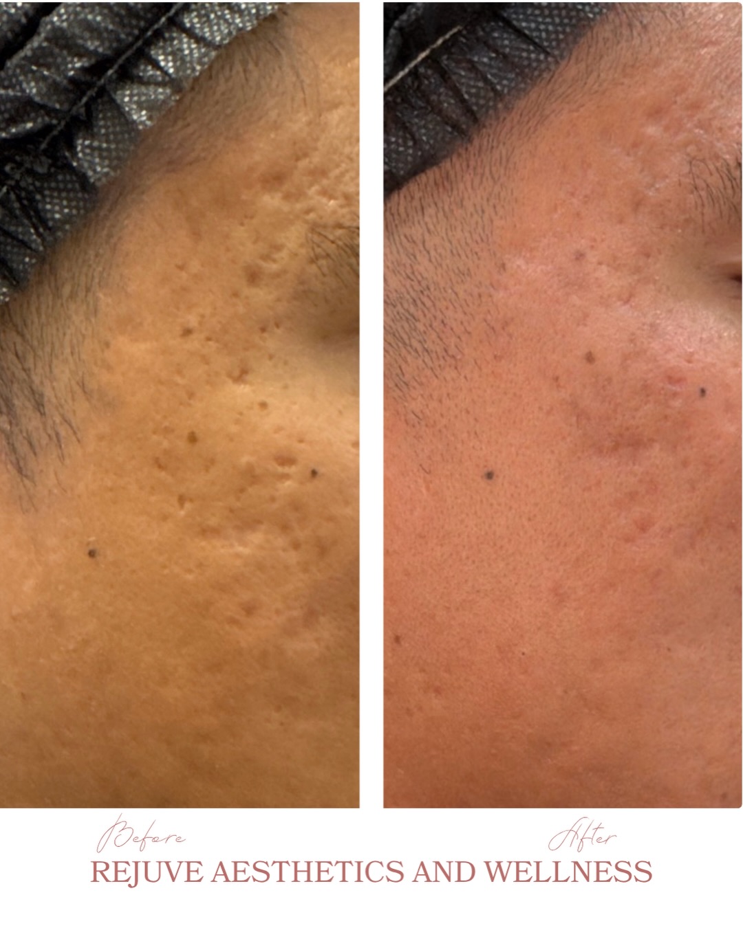 From texture chaos to smooth canvas đ
This is what 3 microneedling sessions can do.
But hereâs what made this transformation happen FASTER:
â¨treatment stackingâ¨
We didnât just microneedle and wait. We layered in skin boosters during each session to amplify collagen production, heal the skin barrier and keep the skin hydrated.
Microneedling creates controlled micro-injuries that trigger your skinâs natural healing response. Then the skin boosters flood that healing tissue with nutrients, so your skin doesnât just repair, it rebuilds stronger, plumper, smoother. đŠââď¸
This is how we get you to your goals without waiting forever. Strategic stacking means faster results that actually last. đŞ
Your skin doesnât work on your timeline, but we can work smarter with the right treatment combinations.
Save this for inspo, comment STACKING to start your transformation. đş