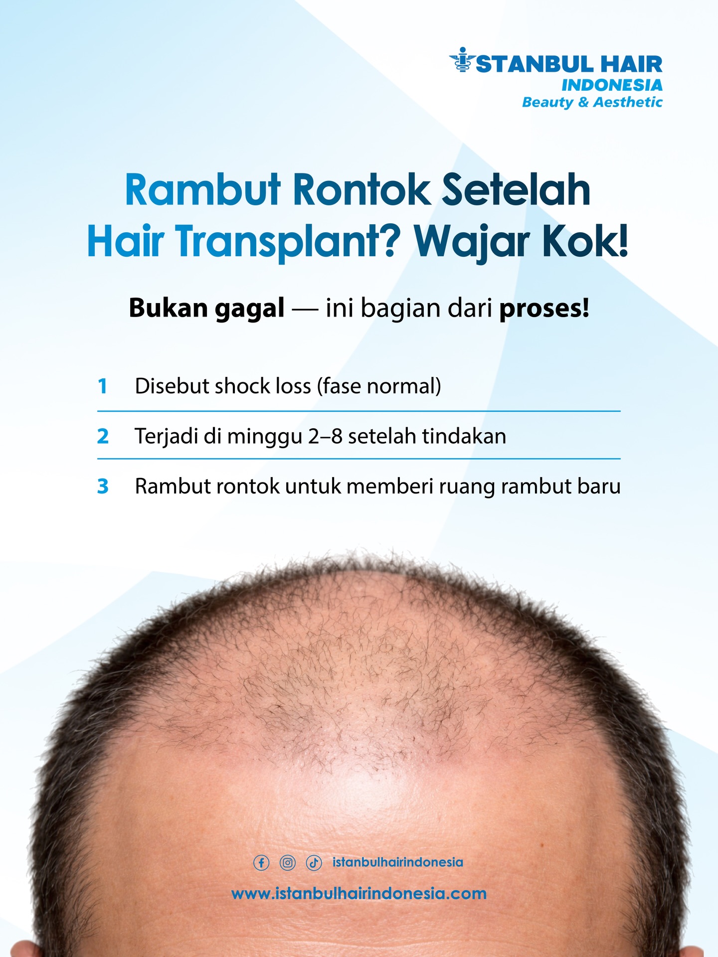 Baru hair transplant… tapi rambut malah rontok? 😰
Tenang, kamu nggak sendirian — dan ini bukan tanda gagal.
Faktanya, fase rontok setelah transplant (shock loss) itu normal banget. Justru ini bagian dari proses sebelum rambut baru tumbuh lebih kuat 💪
Yang perlu kamu ingat:
Rontoknya sementara, akarnya tetap aman ✔
Dan dalam beberapa bulan, rambut baru akan mulai muncul ✨
Jadi… jangan buru-buru panik ya.
Trust the process, hasil bagus lagi “dipersiapkan” 😉
📩 Masih ragu atau mau tanya kondisi kamu?
FREE konsultasi sekarang!
💬 DM kami
📲 WhatsApp: 0857 1001 6600
#hairtransplantindonesia #rambutrontok #perawatanrambut #hairgrowthjourney #istanbulhairindonesia