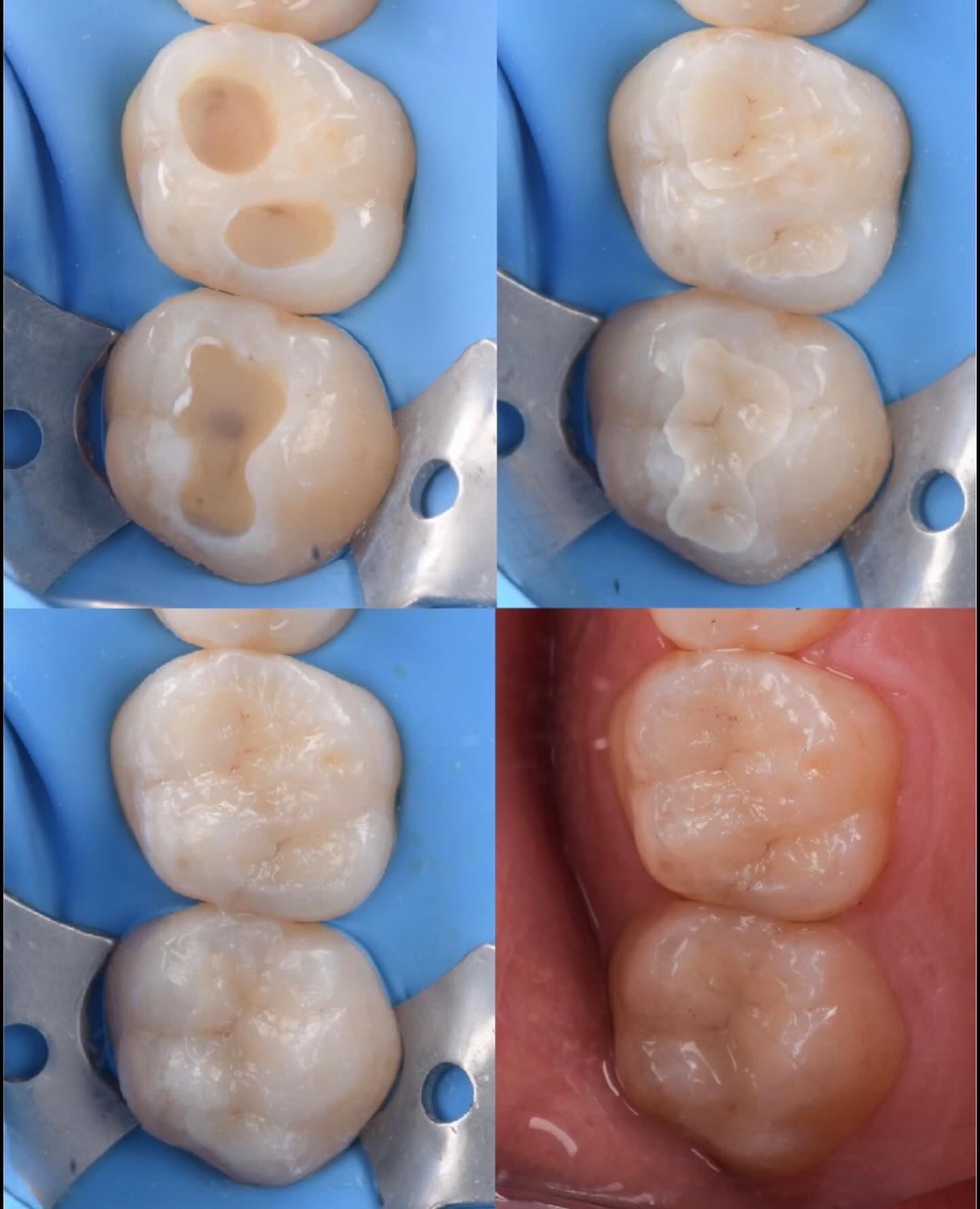 In this patient, we performed feldspathic ceramic inlays. The patient is highly material-conscious and works in the medical field. He specifically requested to avoid composite resin and preferred the most inert material available.
For this reason, ceramic was chosen, as it remains one of the most biocompatible and stable options. Small feldspathic ceramic inlays were therefore placed on both molars to meet these expectations while ensuring optimal biology and durability.