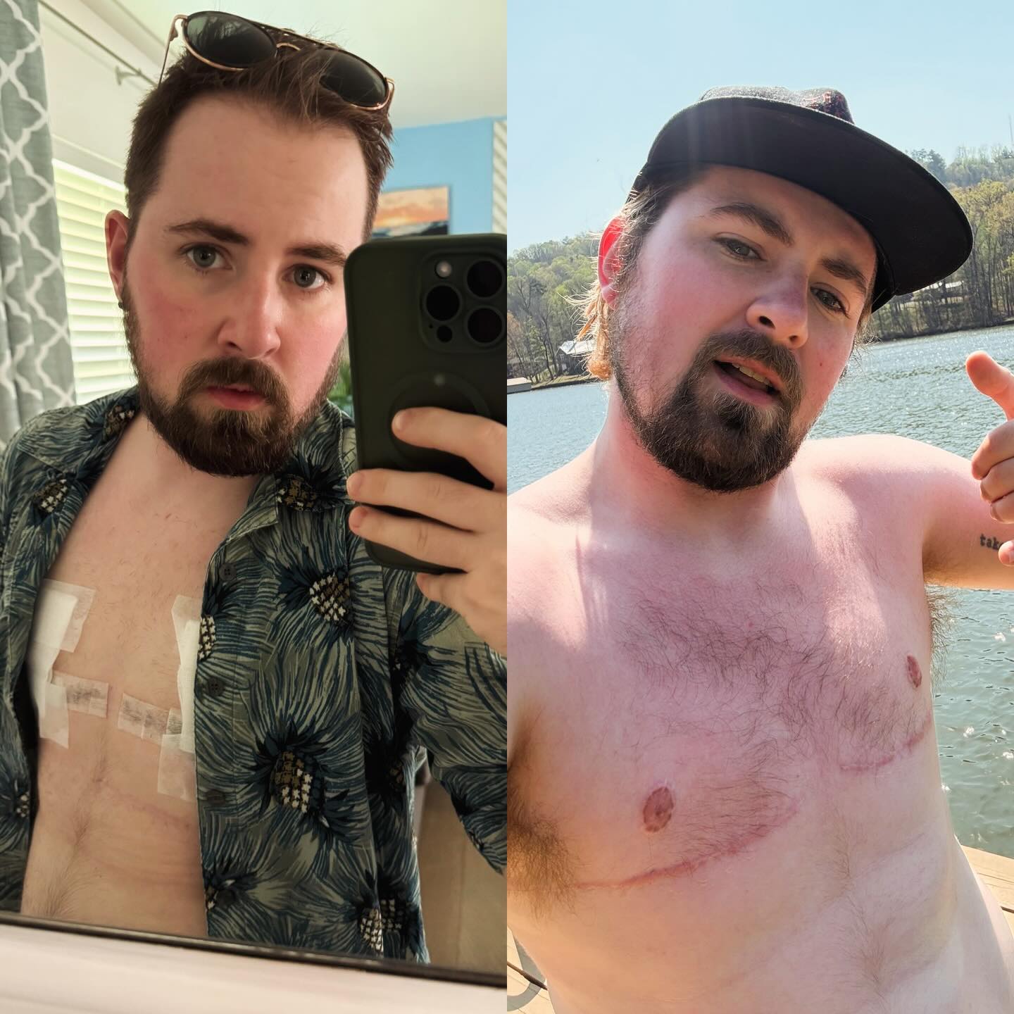 over a year post-op. finally thrilled to be in the skin i’m in. shout out to @drcharlesgarramone and team for the ease of the journey last year.