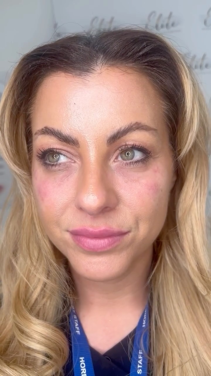 Tired eyes even when you’re well rested?
This is your under-eye glow-up…
Tear trough filler is designed to soften hollows, reduce the appearance of dark circles, and restore lost volume under the eyes — giving you a brighter, smoother, more refreshed look without looking “done”.
What can it do?
It helps improve under-eye shadows, smooth tired-looking hollows, and create a more youthful, awake appearance — all while keeping results natural and balanced to your face.
At Elite Nurse Led Aesthetics, Wakefield, we specialise in subtle transformations that enhance your features and boost your confidence.
💫 Imagine looking as refreshed as you feel.
👉 Book your consultation today and let’s create your under-eye transformation.
#TearTroughFiller #UnderEyeRefresh #EliteAesthetics #WakefieldAesthetics #NaturalResults