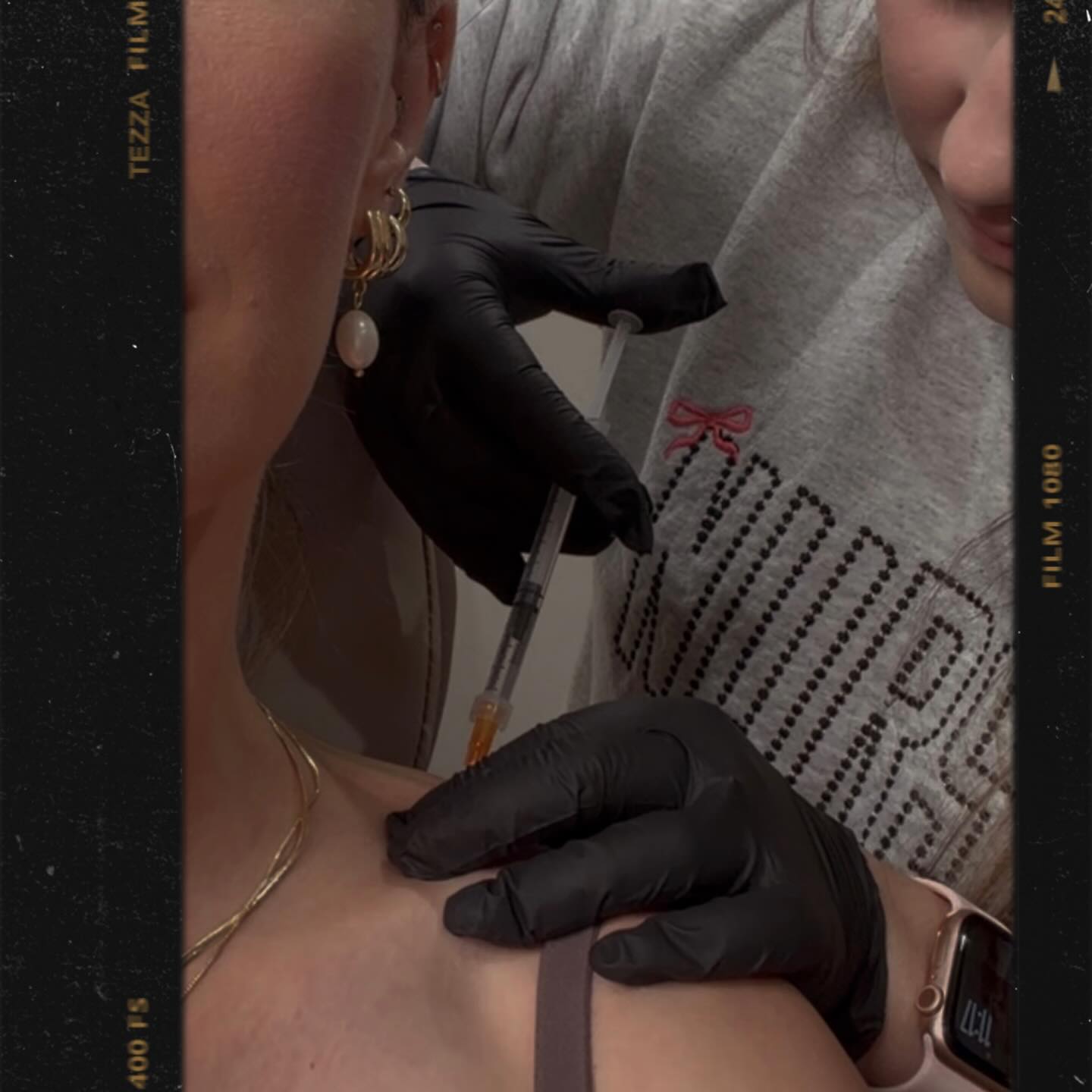 Trap Botox is officially at Bloom. 💉This treatment involves injecting Botox into the trapezius muscles to help relax them giving you that slimmer, elongated neckline while also relieving built-up tension in the shoulders.