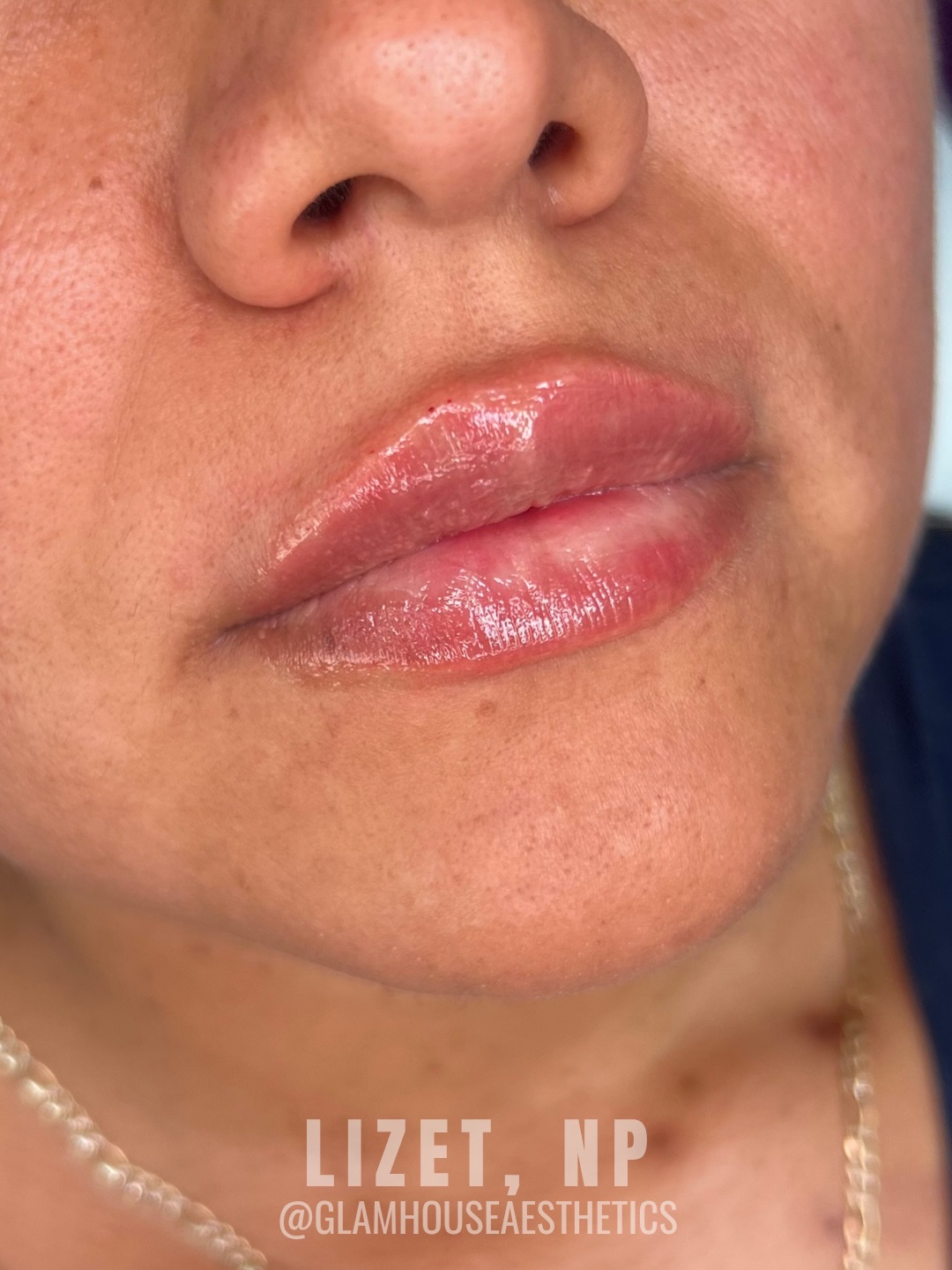 Soft volume, clean shape, and just enough gloss to catch the light â¨
Ready for your lip filler? Contact us today to schedule your appointment đ
#GlamHouseAesthetics #NewBraunfelsMedspa #SanAntonioMedSpa #lipfiller #RestylaneKysse