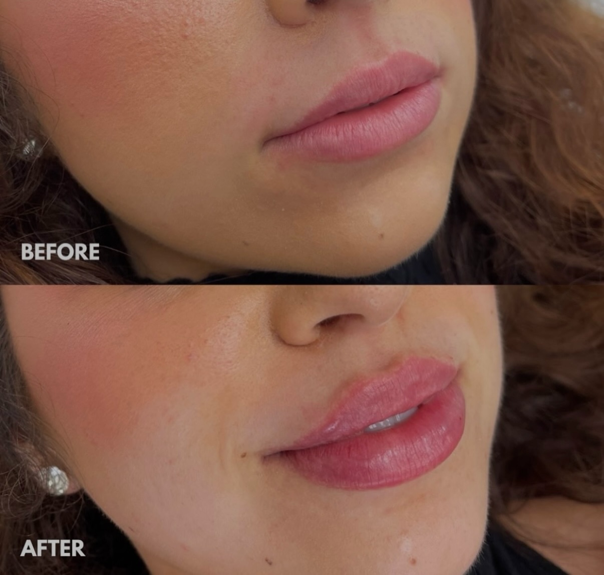 💉 Thinking about lip filler but want a natural result?
One of the most common questions we hear is: Can 0.5 ml lip filler look natural?
For many first-time clients, the answer is yes. A subtle amount can enhance shape, improve balance, and add soft hydration without creating an overfilled look.
At Lana Skyn Amsterdam, treatments are personalised to facial proportions and individual goals. Led by Lana Zevnik, the focus is always on elegant results that still look like you.
Curious if 0.5 ml is the right choice? Book a consultation and get honest advice.
📍 Amsterdam
✨ Natural Lip Fillers
📩 Book now
#lanaskyn
