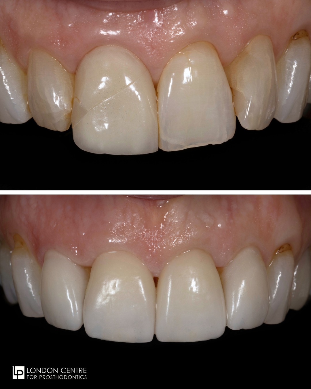 Over time teeth and restorations fail. This wonderful patient did not like the appearance of her upper front teeth. They were grey and cracked. She also had a veneer on her upper right central incisor that had cracked and was repaired in the past. She wanted to improve the appearance of her teeth in the most conservative way possible. We were able to achieve an amazing improvement by restoring her upper incisor teeth with new custom fabricated ceramic veneers.
It was a privilege to experience her restored confidence with a beautiful smile and natural looking teeth. Special thanks to our master dental technician undefined.
Get in touch with our team to book your appointment - we look forward to seeing you soon!
The London Centre For Prosthodontics
29 Weymouth Street
London, W1G 7DB
020 7637 4518
info@londonprosthodontics.com
Monday - Friday: 7:30am - 4:30pm
#SmileMakeover #EmergencyDentistLondon #LondonDentalClinic #SmileTransformation #CosmeticDentistLondon