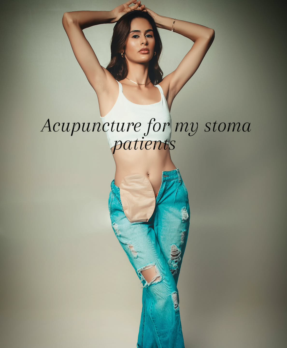 Many people assume acupuncture is only useful in the immediate recovery phase after surgery, but some of the most helpful work I do is with my long-term stoma patients.
Months or even years later, the body can still be trying to find its balance.
I support people living with a stoma who are experiencing a whole raft of issues including:
Ongoing digestive discomfort bloating, cramping, irregular or unpredictable output
Abdominal tension, tightness around the stoma site and surrounding tissues
Chronic pain, including scar sensitivity and deep internal discomfort
Nervous system dysregulation, the body staying in a subtle state of stress or vigilance
Fatigue, especially when digestion isn’t functioning smoothly
Emotional holding, frustration, anxiety, or disconnection from the body
Acupuncture works by helping the body regulate, soften, and reconnect.
Over a course of treatment, I often see: More consistent, comfortable digestion
Reduced pain and abdominal tightness
A calmer, more settled nervous system
Better energy and resilience
A renewed sense of trust in the body and confidence
Living with a stoma long-term is not just about “coping”, it’s about finding ease again.
This is the work I love. Quiet, steady, deeply supportive.
#acupuncture #stomalife #digestivesupport #chronicillnesssupport #takecontrolofyourwellbeing nervoussystemregulation integrativecare