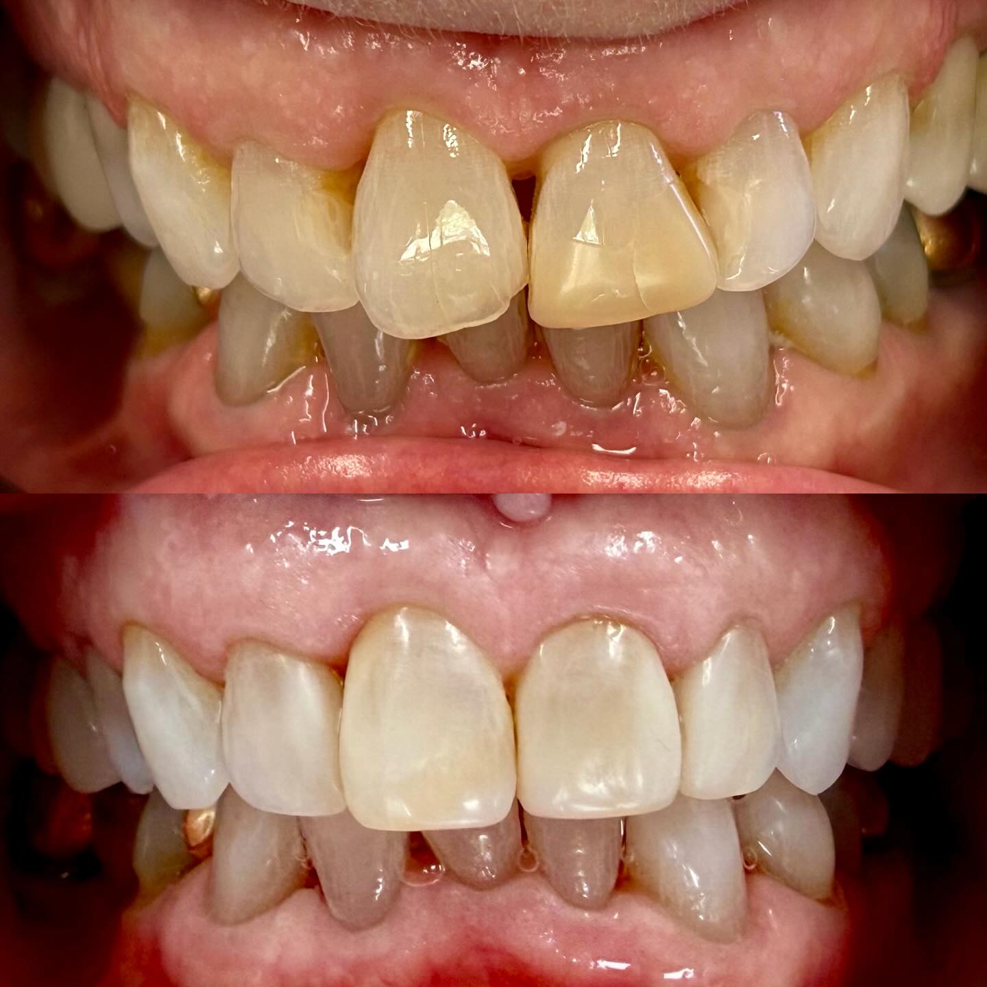 A little bit of bonding can go a long way!! 🤩🦷🔥❤️ This patient desired whiter and straighter looking teeth on a budget and a time constraint. She did not want to spend the money on crowns or veneers and had realistic expectations for Dr. Lohr. We bleached her teeth and used composite resin to reshape the teeth. She was quite pleased with the results! 🙌🏻 #smileofyourdreams #cosmeticdentistry #drlohrdds #lohrfamilydentistry #clearaligners