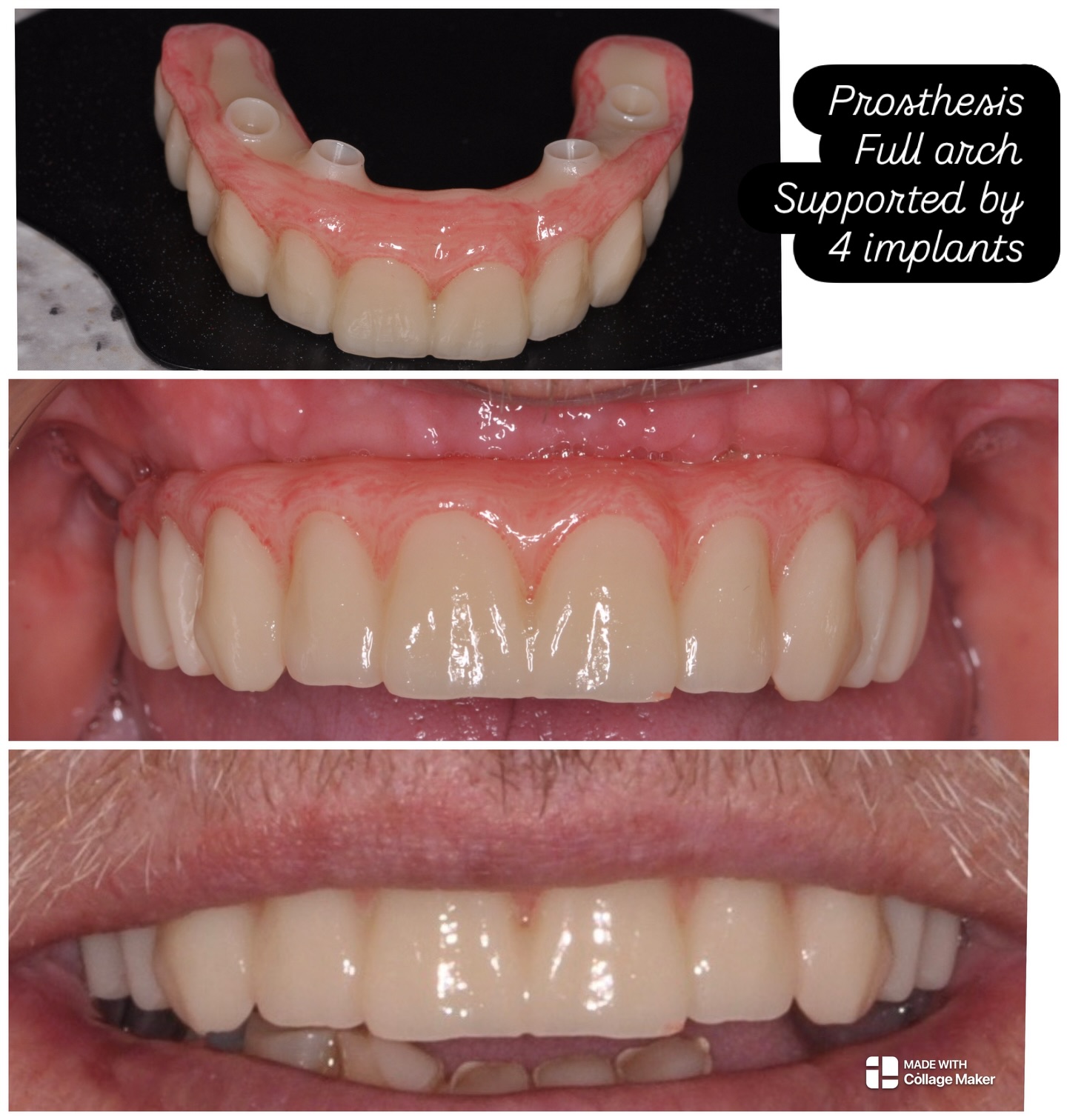 Interim prosthesis on a full arch case #allon4manchester #immediatefullarchloading #dentalimplantsmanchester #dentalimplants #implantologydentistry