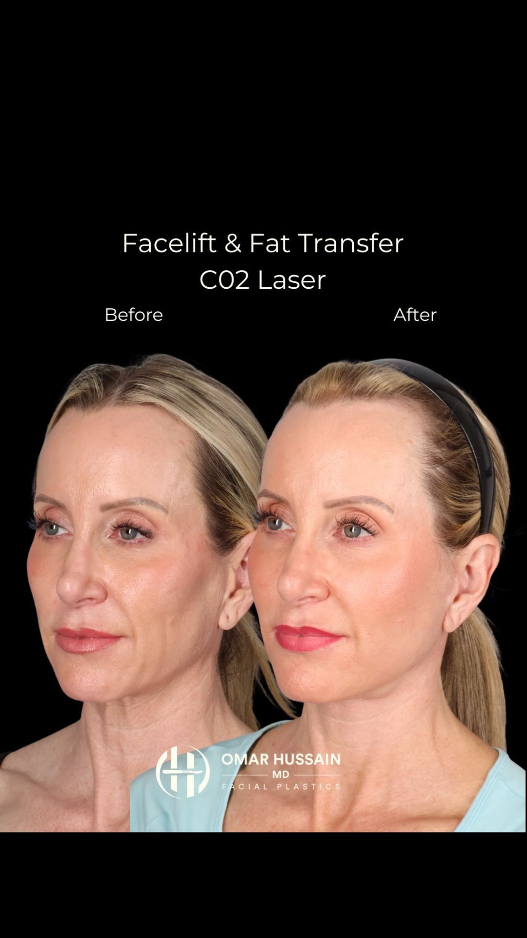 Her goal was simple: look refreshed and take 5–10 years off—while still looking completely like herself. ✨
With a facelift, fat transfer, and CO2 laser, we restored youthful structure, softness, and skin quality in a natural, balanced way.
#facelift #fattransfer #facialrejuvenation #naturalresults #beverlyhillsplasticsurgeon