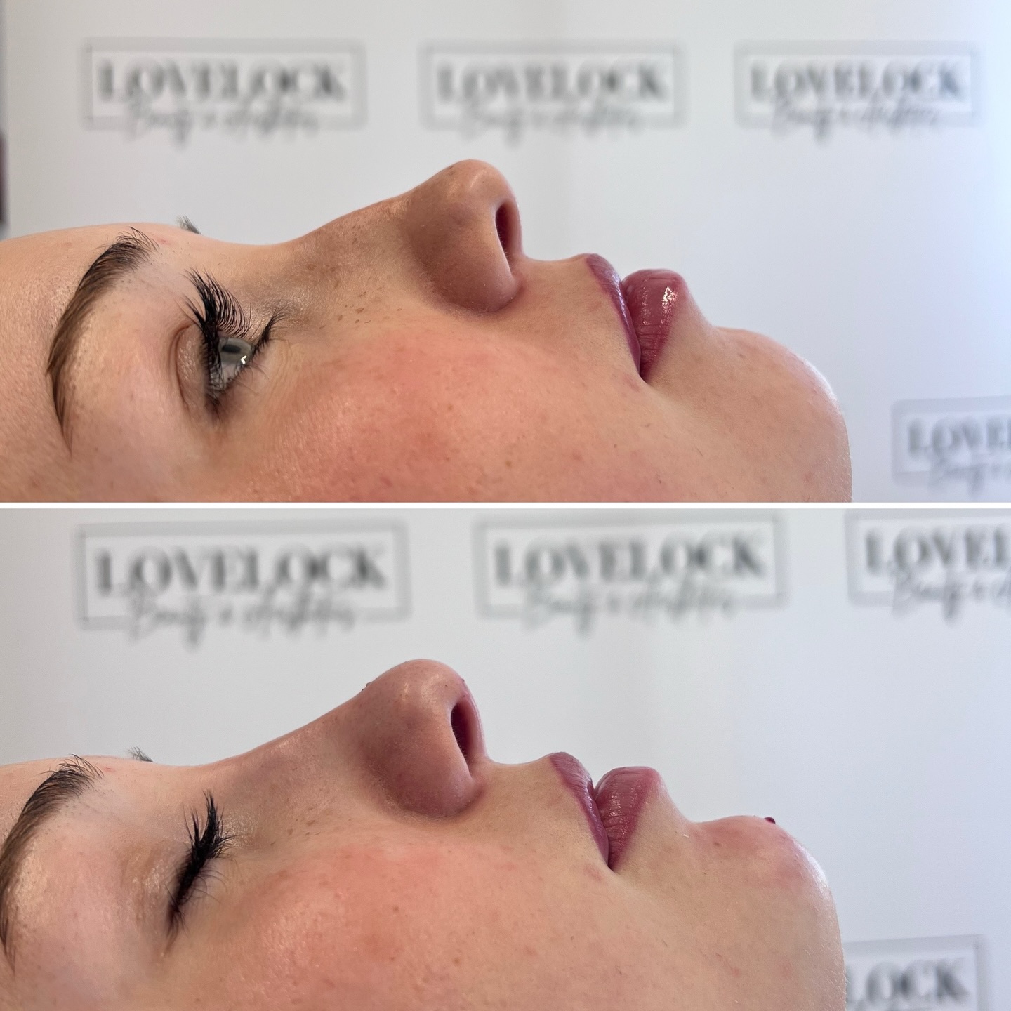 New nose and chin for my lovely client ❤️
Award Winning Level 7 Expert Practitioner
📍 Warminster 📍 Romsey
#warminster #westbury #trowbridge #melksham #frome