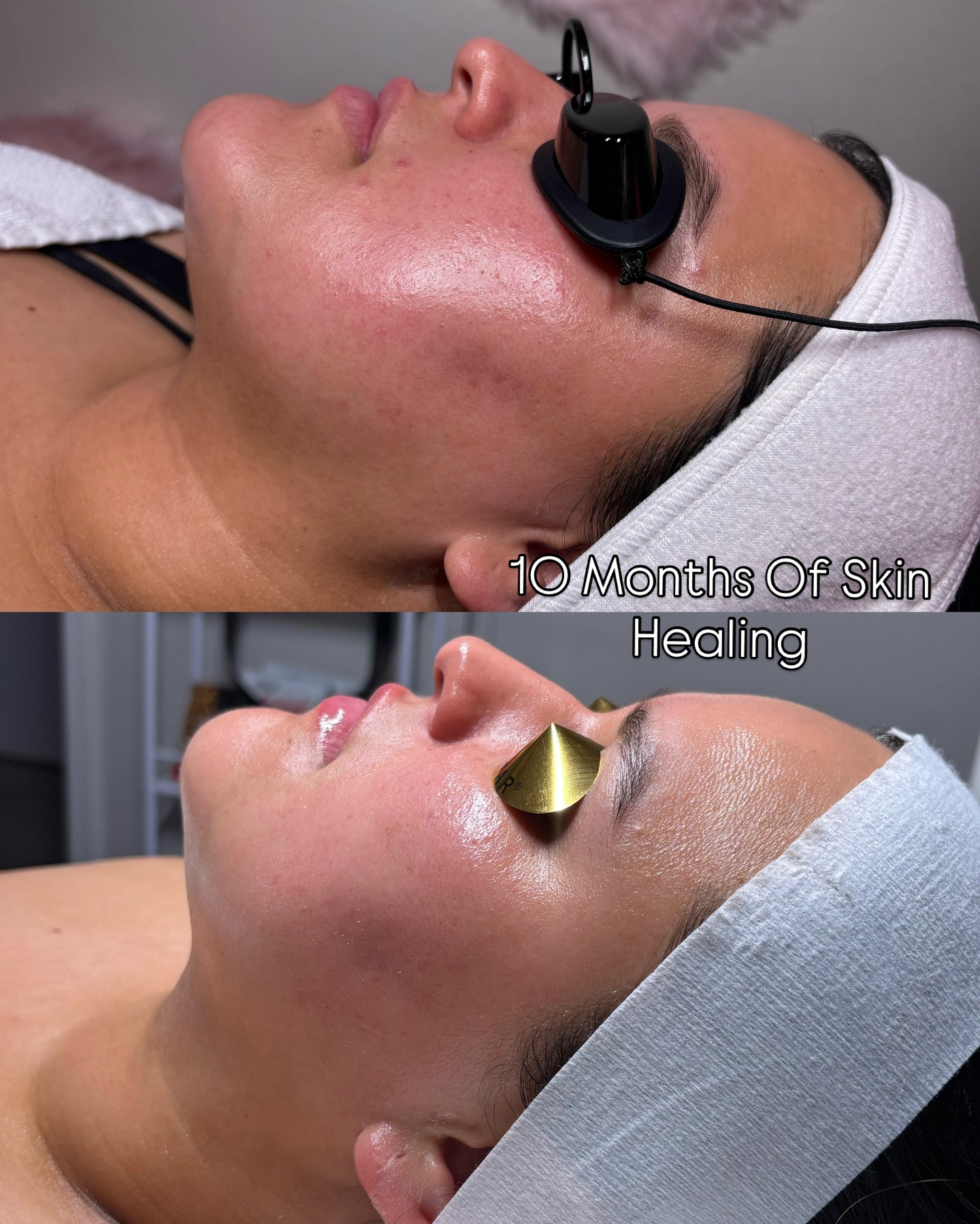 True skin healing transforms from the inside out. 🤍🥺
Services we did to achieve these results:
• The Monthly Skin Membership
• Microneedling
.
“to give them a beautiful headdress instead of ashes, the oil of gladness instead of mourning, the garment of praise instead of a faint spirit…”
- Isaiah 61:3 †