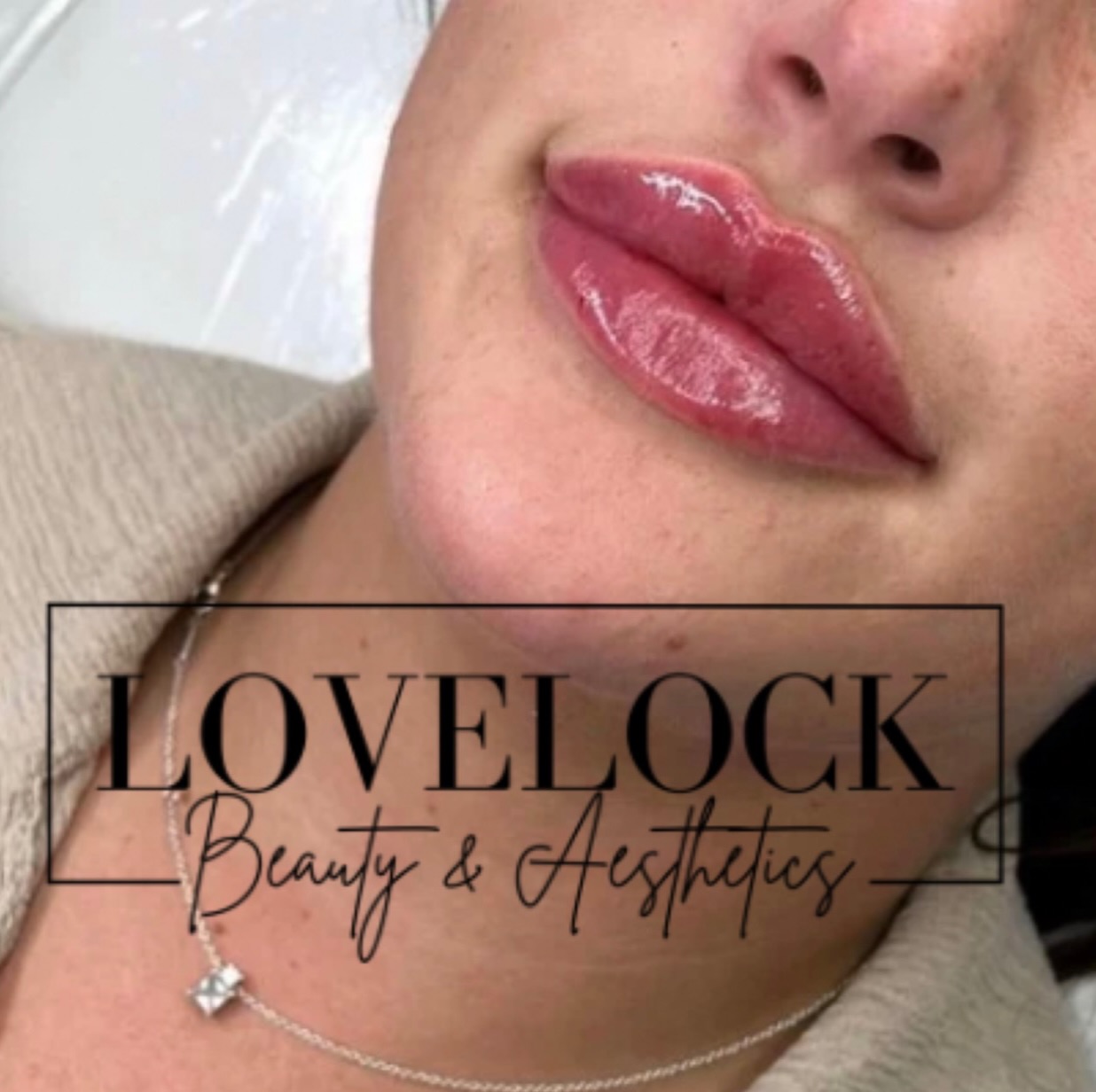 A little tweak, a lot of confidence 💋
Lip filler uses hyaluronic acid to add volume, shape, and hydration – think your lips, just a juicier version 😉 Whether you want a subtle glow-up or a bit more definition, it’s all about enhancing what you’ve already got… with a fun little boost 💉✨
#warminster #trowbridge #westbury #melksham #corsham