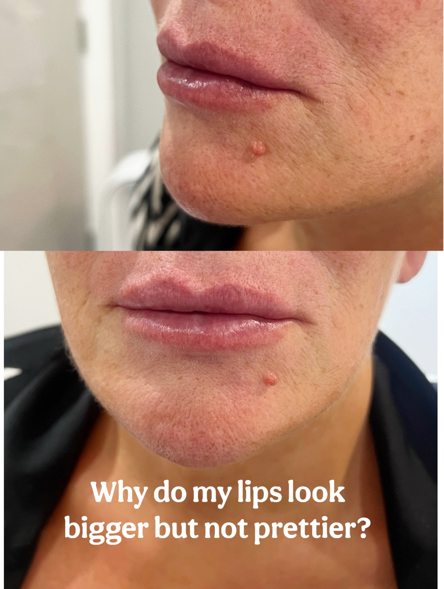 Sometimes the best lip filler appointment starts with dissolving. Reset the shape, then enhance subtly 🤍💉
Book your appointment via the link in bio🔗
#lip #natural #surbiton