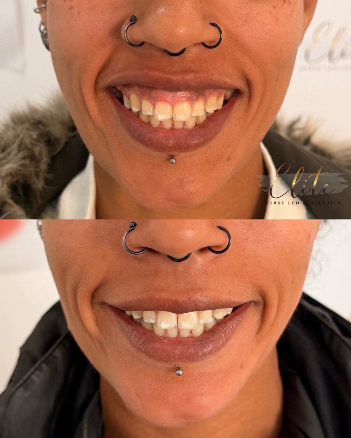 Do you hide your smile because of your gums? ✨
A gummy smile treatment at Elite Nurse Led Aesthetics in Wakefield can subtly transform your smile by:
- Relaxing the upper lip to reduce gum exposure
- Creating a more balanced, natural-looking smile
- Boosting your confidence instantly
- Delivering quick, non-surgical results with minimal downtime
It’s a small tweak that makes a big difference ✨
Stop holding back your smile and start loving it 💕
📩 DM us or call today to book your consultation and achieve your perfect smile!
#EliteAesthetics #WakefieldClinic #GummySmile #SmileConfidence #AestheticTreatments