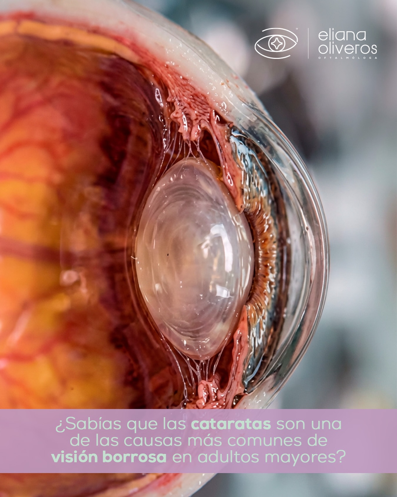 Con el paso del tiempo, es natural que la visión pierda nitidez o que los colores se perciban diferentes 🎨
En muchos casos, estos cambios están relacionados con alteraciones en el lente natural del ojo, como ocurre con las cataratas, una condición frecuente en adultos mayores 👵👴
🔍Identificar estos cambios a tiempo permite entender mejor lo que está pasando y acompañar cada etapa visual de forma adecuada.