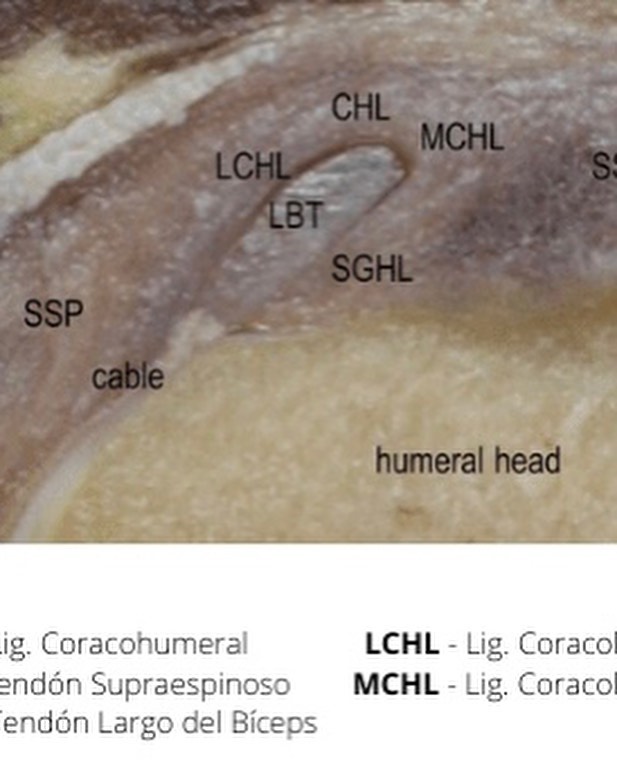 CASO CLÍNICO: Capsulitis adhesiva del hombro/Capsulitis retráctil/ Espalda congelada
En mi opinión, una de las patologías de hombro más complejas y difíciles de gestionar para quien la sufre. Se trata de un proceso de larga duración, en el que principalmente, el paciente experimenta progresivamente un cuadro de dolor generalizado en el hombro y una pérdida de movilidad progresiva, que va avanzando si no se trata de manera apropiada.
Suele afectar a pacientes de mediana edad (40-50 años) y su origen puede ser secundario a otra lesión anterior, a raíz de un traumatismo sobre la zona o de origen idiopático (sin una explicación clara).
El diagnóstico suele ser principalmente clínico, caracterizado por:
🛑 Dolor generalizado en el hombro
🛑 Perdida de movilidad activa y pasiva (vídeo)
‼️Además, los síntomas inicialmente, suelen confundirse con los típicos que podría presentar una tendinopatia del supraespinoso
A nivel de pruebas de imagen, no suelen apreciarse grandes alteraciones, por lo que no suele correlacionar con la sintomatología del paciente (imagen 4).
Uno de los hallazgos que si podemos encontrar a nivel ecografico, suele ser una hipertrofia (engrosamiento) de los ligamentos que rodean la porción larga del bíceps (imagen 2) y si utilizamos el doppler, podemos observar un aumento de la captación en la zona (imagen 3).
🟢El abordaje más apropiado para esta patología se debe fundamentar en trabajar la movilidad de la articulación glenohumeral y el complejo del hombro, tanto de forma activa como pasiva. Y fomentar que el paciente realice trabajos de movilidad activa en casa de forma diaria, bajo tolerancia.
Muchas gracias a @aloha2rius por permitirme compartir el caso abiertamente y cederme sus imágenes 🙏
#fisioterapia #fisioterapiaesportiva #rehabilitación #dolorhombro #lesioneshombro #capsulitisadhesiva #dosrius #argentona #mataró #llinarsdelvalles #ecografía