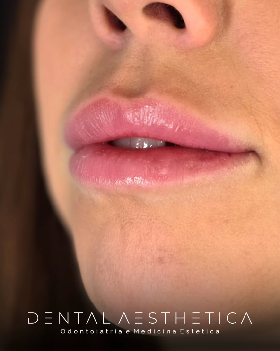 Un po' filler per donare volume e idratazione alle labbra?
Dental Aesthetica
✨️ Odontoiatria e Medicina Estetica
📍 viale della Grande Muraglia 256 - zona EUR Torrino
📱 3758847069
#filler #fillerlabbra #lipfiller