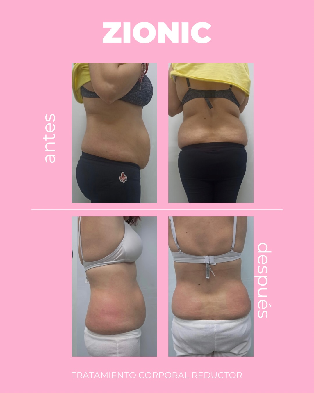 Cambios increíbles desde la 1ª sesión 🌸
Zionic es el aliado perfecto para la operación bikini.
¿Quieres cita para tu valoración GRATUITA?
Escríbenos o ven a vernos en 📍Avenida Mirat, 9 (Salamanca)