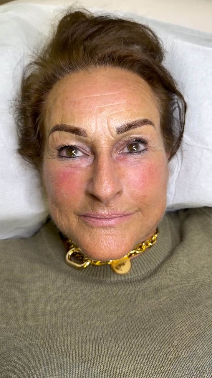 Struggling with your brows every morning? Feeling stressed because you just can’t get them right?
She had some natural hair, but no shape—and filling them in wasn’t a skill she had. Every day felt frustrating.
Together, we chose Power Brows: a personalised design with a soft makeup effect, using selected pigments like Dark Brown by @tinadaviesprofessional , professionally sourced from @id_liner_pmu .
Now she saves time and feels confident. ✨
If this is you, it’s time to book your appointment.
#pmu #powderbrows #cardiffbrows #browsonfleek #permanentmakeup