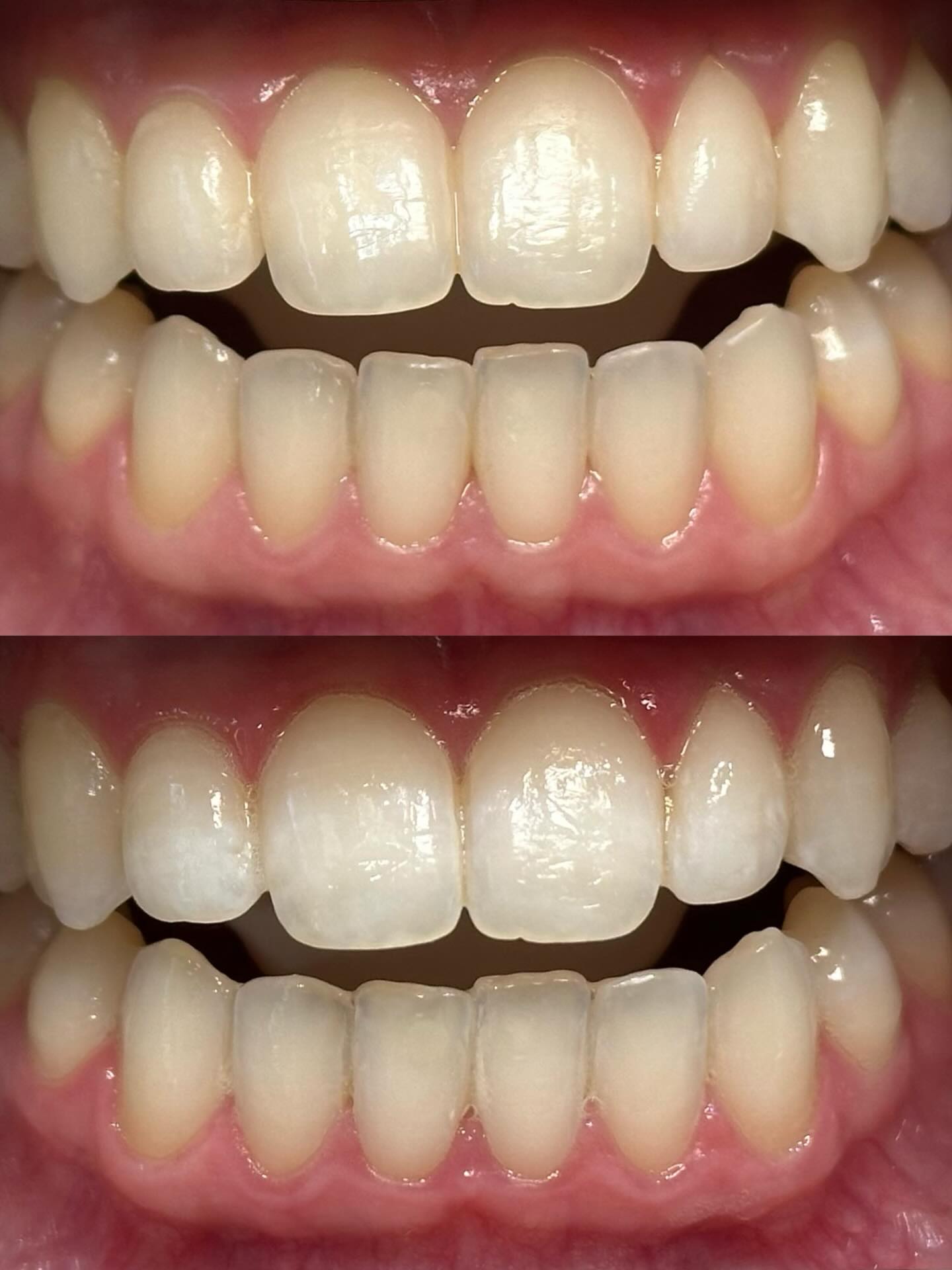 A brighter smile… but still you ✨
Customized cosmetic teeth whitening designed to enhance your natural smile, no overdone look, no harsh sensitivity, just a clean, brighter result 🦷💫
📍 Naperville, IL
serving Chicagoland
#teethwhiteningnaperville #napervilleteethwhitening #chicagoteethwhitening #napervillebeauty #chicagolandbeauty