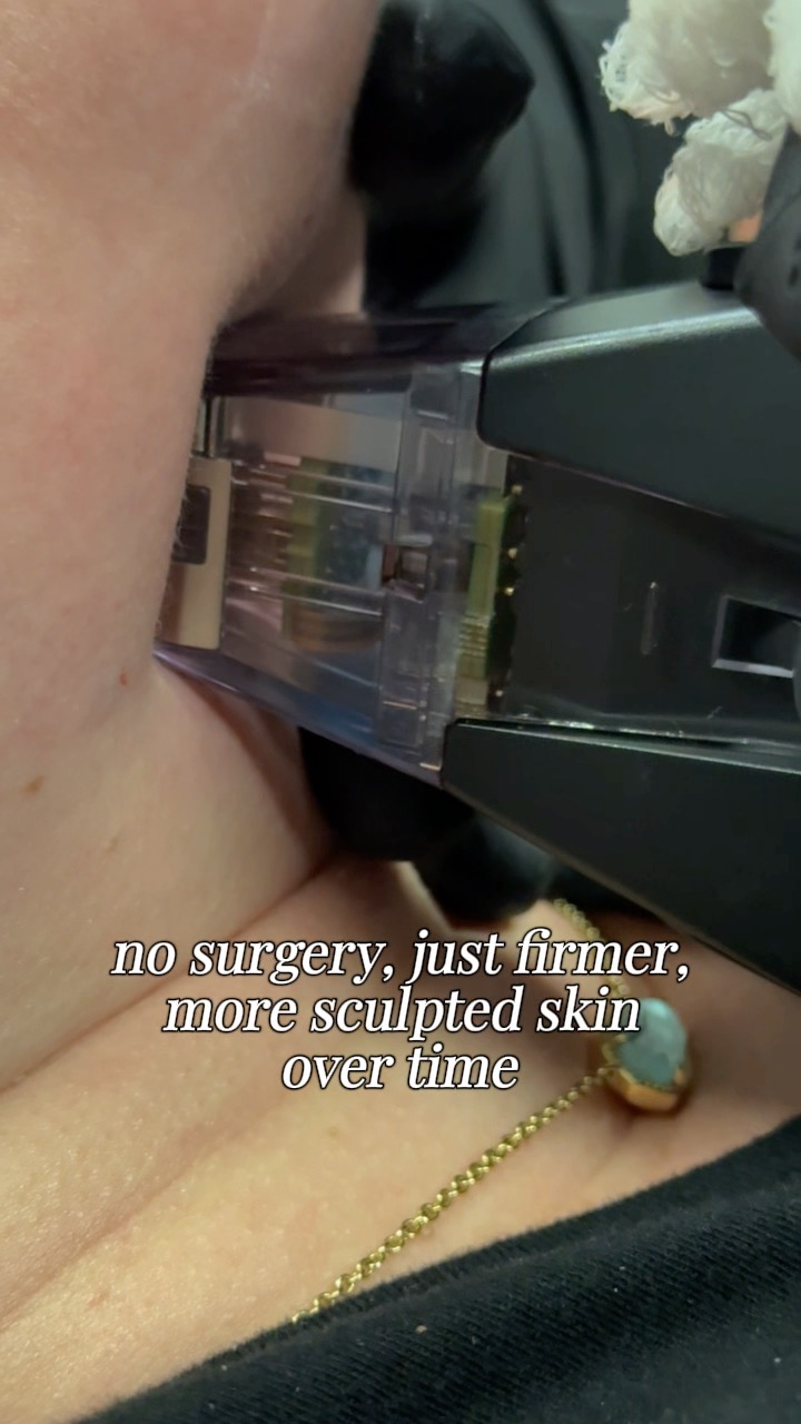 The treatment behind the lift âĄď¸
Morpheus8 is not just microneedling. It combines it with radiofrequency energy to reach deeper layers of the skin and stimulate collagen production from within.
For areas like the neck, that means improving skin laxity, softening fine lines, and creating a smoother, more supported look over time. What really matters here is control.
Depth and energy are adjusted based on your goals. Tightening, refining, or subtle contouring. Every treatment is customized so the result looks natural and balanced.
No surgery. No drastic change. Just firmer, smoother skin that still looks like you.
đ Call (318) 698-8711 to schedule your consultation
#Morpheus8 #SkinTightening #NeckRejuvenation #RFMicroneedling #DrKennethSanders