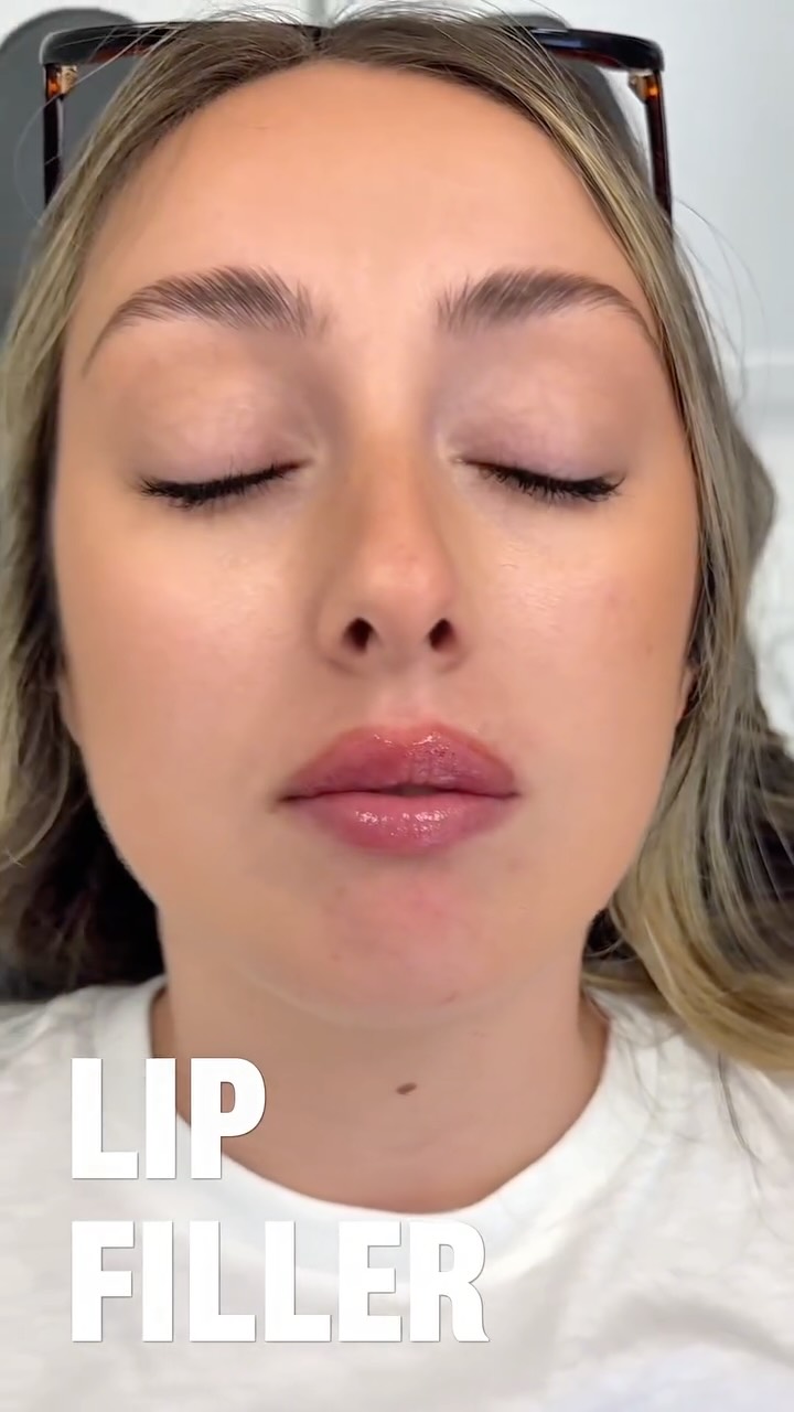 💋 A little volume can make a big difference. Lip fillers designed to enhance your natural beauty while keeping your look soft, balanced, and beautiful. ✨
Call or text today to book your appointment!
☎️ 239-448-3383
📩 chris.jewell@jewellmedicalspa.com
🌐 www.jewellmedicalspa.com | www.mrinjectable.com
📍 1044 Castello Drive, Ste 213 Naples Florida 34103
💳 We Accept Care Credit!
*
*
*
#lipfiller #lipfillers #lipaugmentation #lipplump #lipinjection #lipenhancement
#lipcontouring #restylanelips #injectables #dermalfillers #cosmeticinjectables #aesthetics #beauty #restylane #restylaneusa #naplesbeauty #naplesinjector #medspa #dolllips #lippies #bestaestheticinjectors #beforeandafter