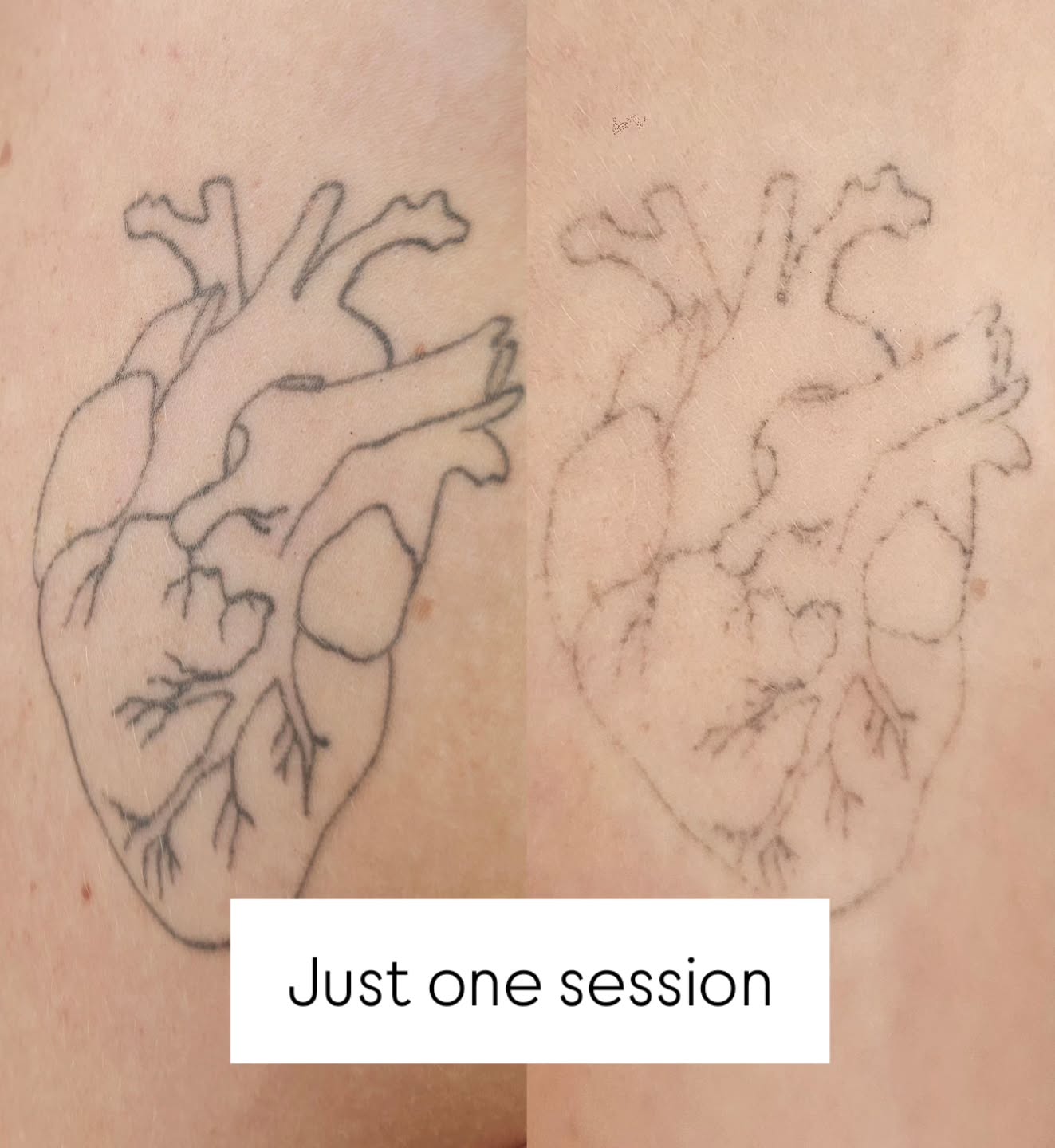 ONE session difference…
This is your sign to stop living with a tattoo you no longer love.
Left ➡️ Before
Right ➡️ After just ONE laser session
You can already see the ink breaking down and fading — and this is only the start. With each session, the pigment continues to lift, leaving clearer skin behind.
✨ Safe, professional laser technology
✨ Minimal downtime
✨ Suitable for most tattoos & skin types
✨ Patch test + consultation required
Most clients need a course of treatments (usually 6–8 sessions) spaced 8 weeks apart for best results.
Ready to start your removal journey?
Book your consultation today — £25 (redeemable against your course)
📍 Essex Beauty & Aesthetics
💻 Book online via the link in bio
💬 DM us “LASER” for more info
#lasertattooremoval #tattooremovaljourney #beforeandafter #aestheticclinic #essexbeauty #inkremoval #skinconfidence #essexlaser #essextattoos #basildontattoo