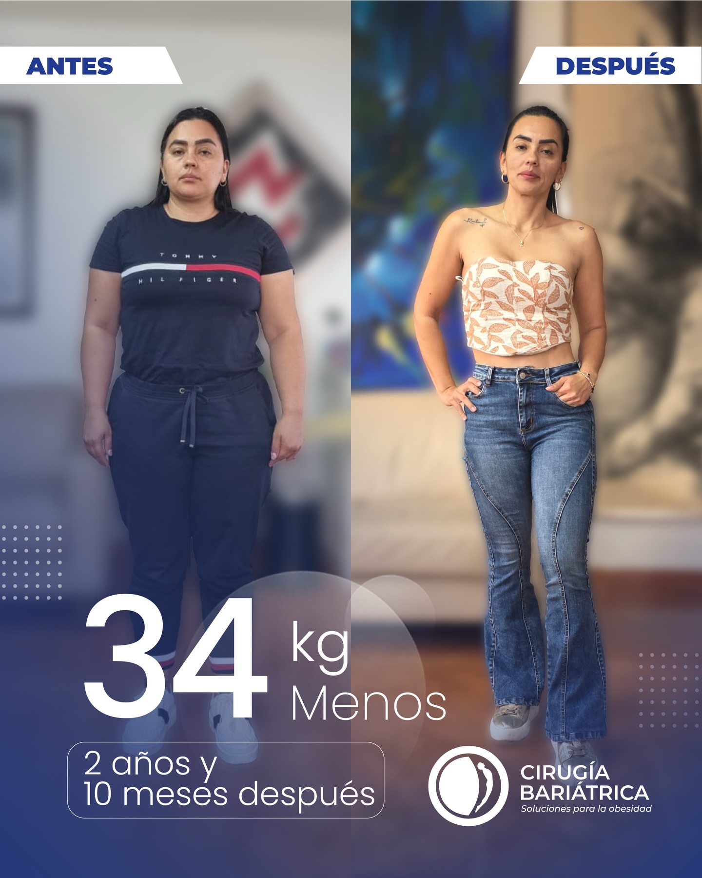 Paciente de control: 34 kilos y 2 años con 10 meses de operada…una transformación que va mucho más allá del físico 🙌🔥
Gracias al Dr. Eduardo Bolaños y su equipo, hoy este paciente experimenta una nueva etapa en su salud después de acceder a la cirugía Bariátrica, con más energía y una mejor calidad de vida 💪✨
Respaldados por tecnología avanzada, experiencia médica y un acompañamiento integral, los resultados reflejan un cambio real y sostenible ✅🏆
📍Agenda tu valoración y da el primer paso hacia tu mejor versión.
#bariatric #bariatricsurgery #bajardepeso #weightlosssurgery #cirugiabariatrica