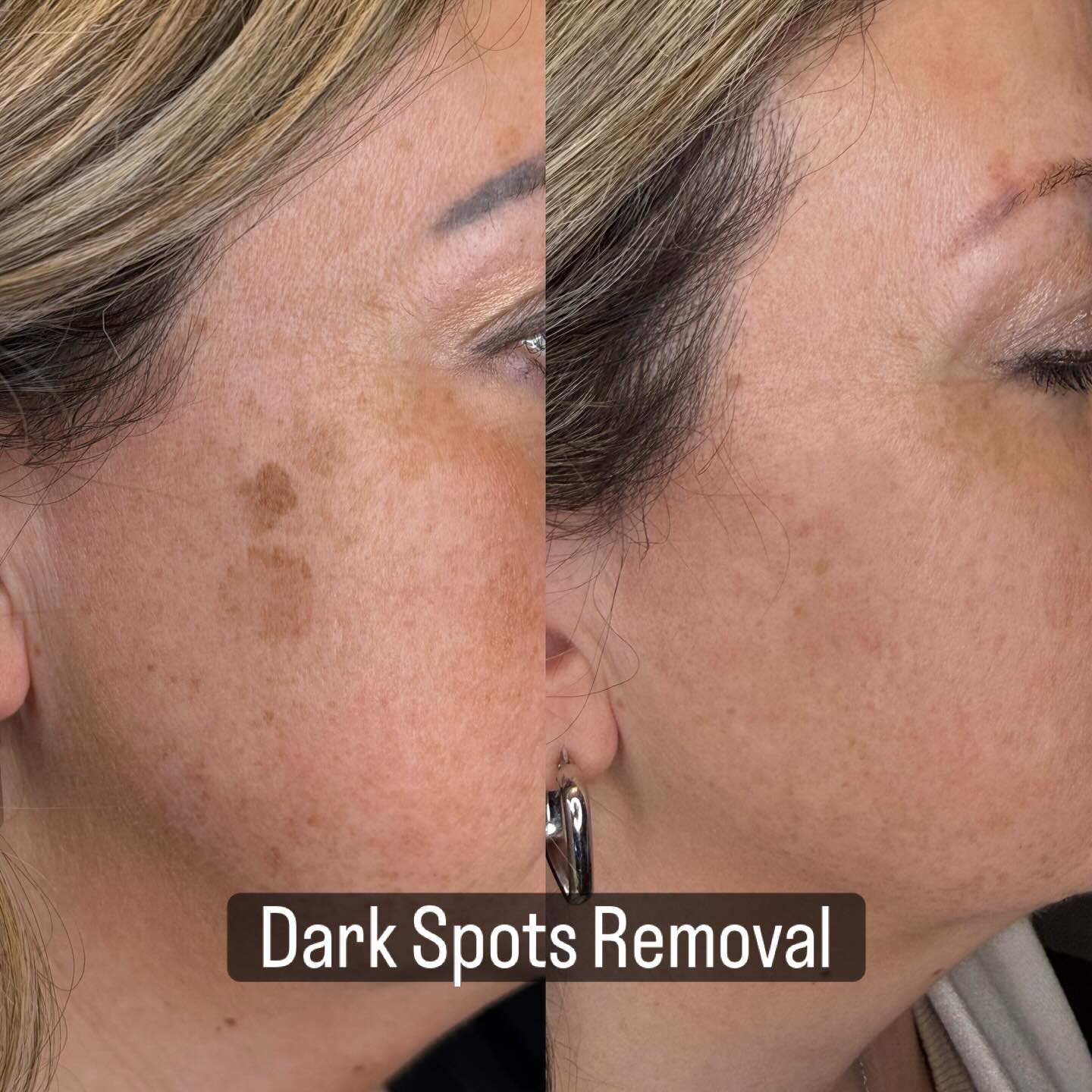 Dark spots? Consider them handled. ✨
This client came in with stubborn pigmentation—and after just ONE treatment, the difference speaks for itself. 🙌 The spots are visibly lighter, the skin tone looks more even
✔️ Non-invasive
✔️ Real, visible results
If dark spots have been bothering you, this is your sign. Results like this are absolutely possible. #Oshawa #OshawaOntario #DurhamRegion #DurhamRegionBusiness #WhitbyOntario