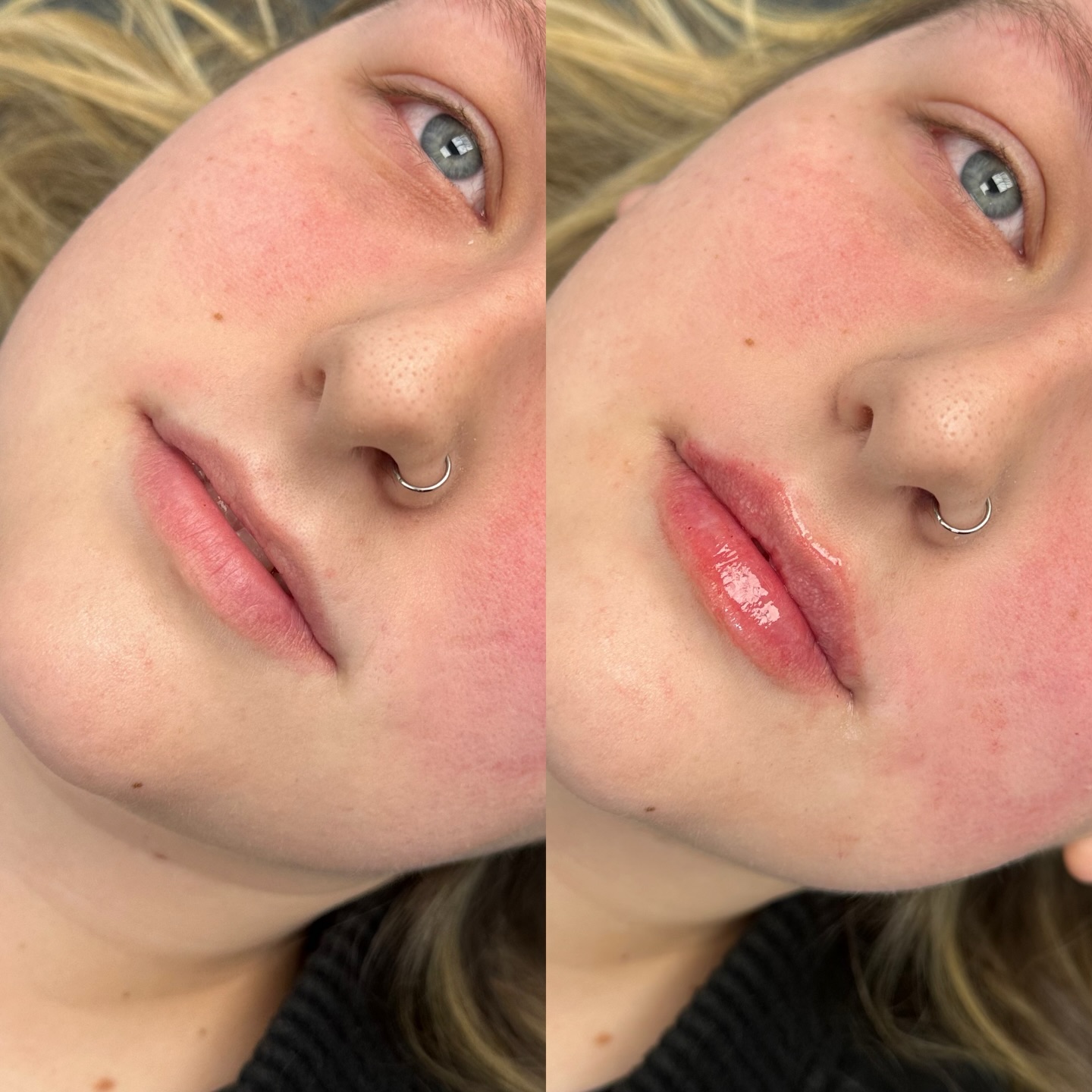 First time filler 💉👄 0.7ml