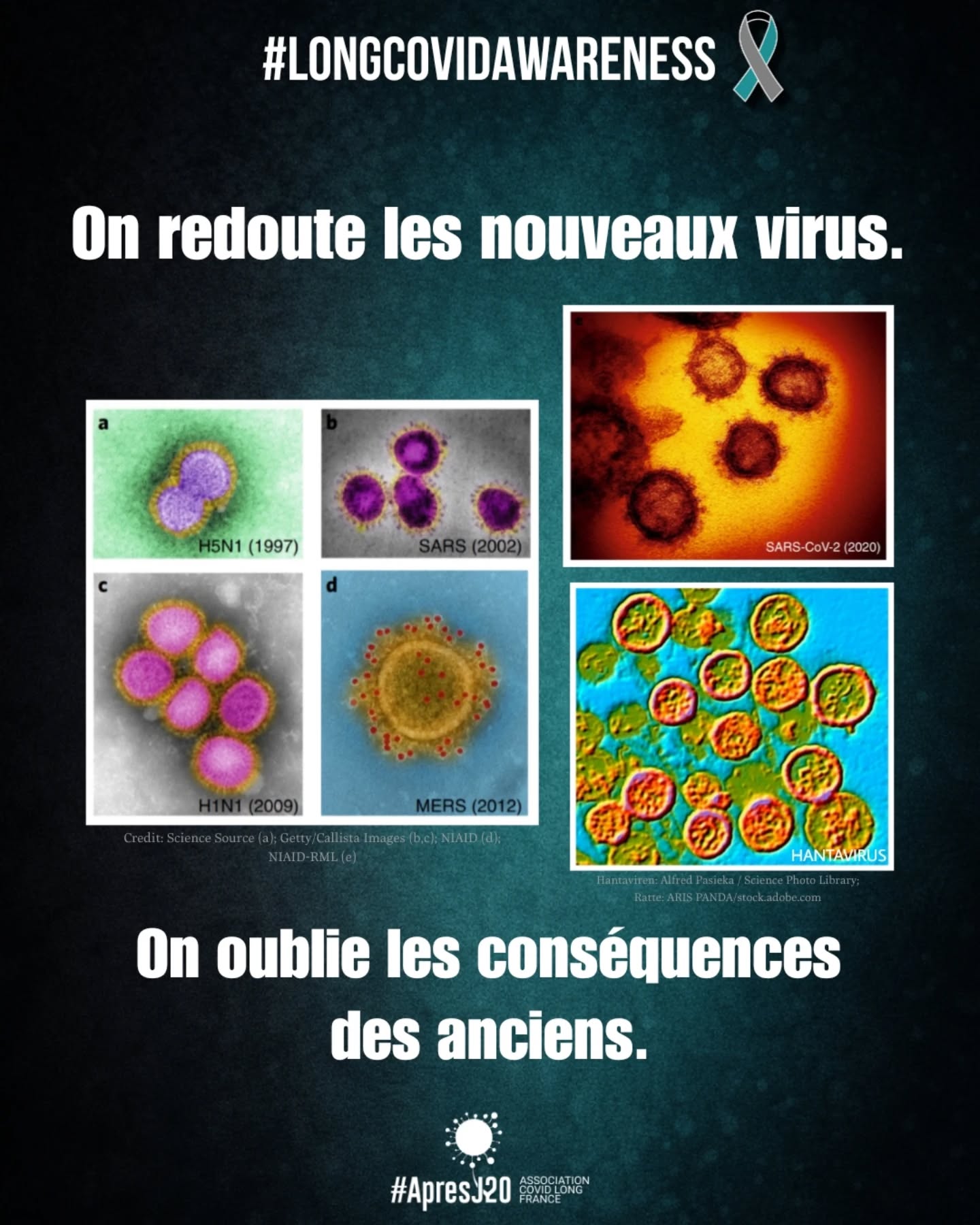 #LongCovidAwareness
đ§”đŠ Le Covid a disparu des discussions.
đMais il nâa pas disparu des vies.
Aujourdâhui, certains sâinquiĂštent Ă juste titre de lâhantavirus.
Pourtant, le Covid continue lui aussi de circuler et de provoquer des formes graves et des #CovidLong
On prend Ă juste titre au sĂ©rieux les risques liĂ©s Ă lâhantavirus. Mais il est tout aussi important de continuer Ă prendre au sĂ©rieux ceux liĂ©s au Covid.
Parce quâun virus frĂ©quent nâest pas forcĂ©ment un virus anodin.
Le Covid Long peut toucher aprÚs une infection légÚre.
Plus de 200 symptÎmes ont été recensés.
Fatigue extrĂȘme, troubles cognitifs, douleurs, difficultĂ©s respiratoires, troubles neurologiques, cardiaques, digestifs, sensorielsâŠ
Les manifestations peuvent ĂȘtre trĂšs variĂ©es, fluctuer dans le temps et devenir profondĂ©ment invalidantes.
Certaines personnes ne peuvent plus travailler, étudier, sortir, faire du sport ou accomplir de simples gestes du quotidien.
Et aujourdâhui, des questions similaires commencent dĂ©jĂ Ă Ă©merger autour de lâhantavirus.
Des articles Ă©voquent chez certains survivants des symptĂŽmes persistants aprĂšs lâinfection : fatigue, difficultĂ©s respiratoires, douleurs ou troubles cognitifs.
https://fr.euronews.com/sante/2026/05/12/le-long-hantavirus-existe-t-il-a-quoi-ressemble-la-vie-apres-linfection
Comme avec le Covid Long, cela rappelle que les consĂ©quences dâune infection ne sâarrĂȘtent pas toujours Ă la phase aiguĂ«.
La bonne nouvelle, câest quâil existe des moyens de prĂ©vention efficaces contre ces infections qui se transmettent par lâair :
đ·porter un masque FFP2
đšpurifier et ventiler lâair intĂ©rieur
đ appliquer les gestes barriĂšres
đ€ Ă©viter les contacts quand on est malade
đąPrĂ©venir reste essentiel !
Le Covid se transmet principalement par lâair.
Un air plus propre protĂšge contre le Covid mais aussi contre dâautres infections respiratoires.
#QAI #AirPur #CleanAir Ventilation
La pandémie de Covid (toujours en cours) aurait dû nous apprendre une chose :
đ face aux maladies infectieuses, la prĂ©vention et lâanticipation sont essentielles
âŹSuite en commentaireâŹ