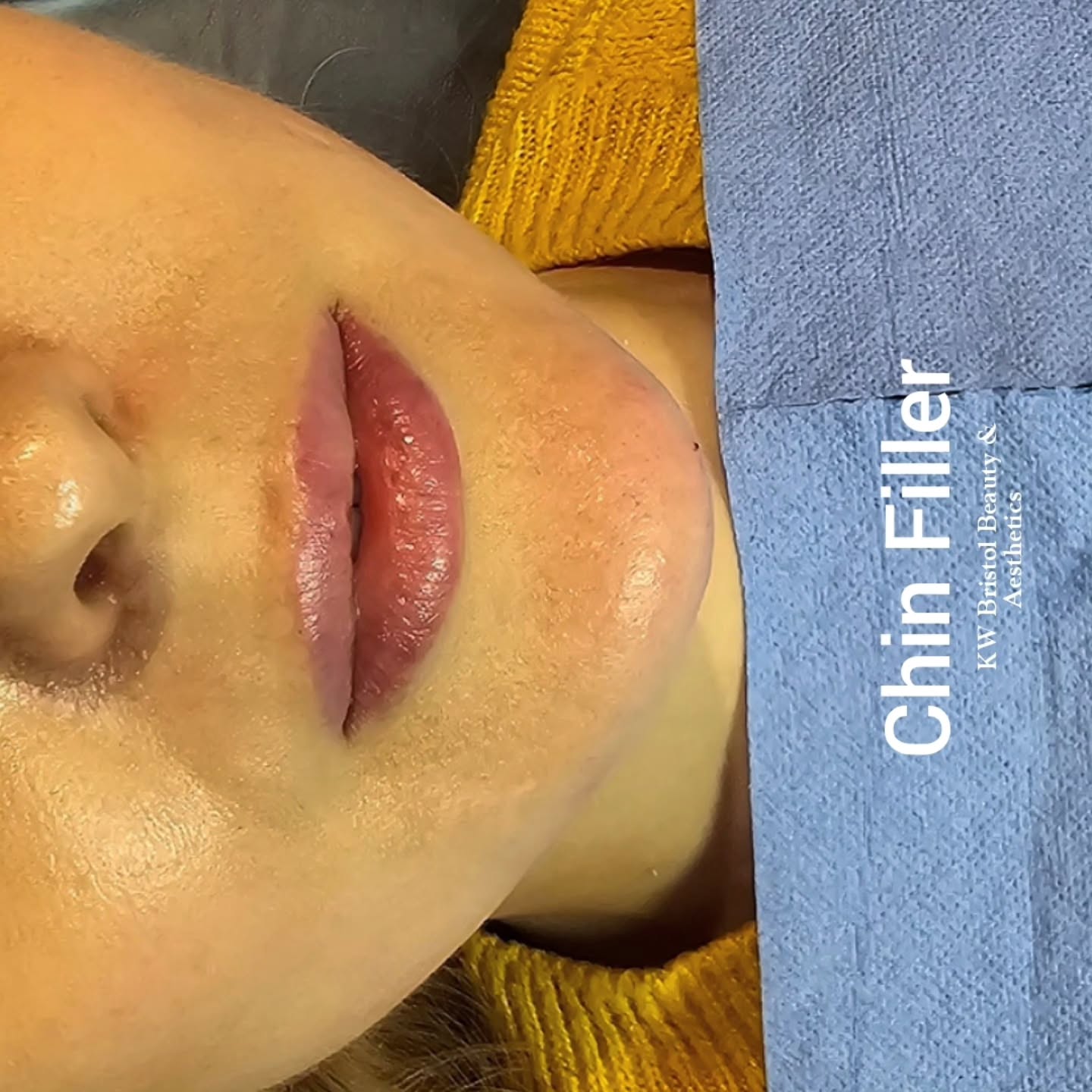 Just wondering about how long chin fillers typically last! 🤔 I've heard they can make a pretty noticeable difference. It's always good to know what to expect before diving into a cosmetic treatment. Anyone have any personal experiences or insights on filler longevity? I'm curious about the average timeframe. It's a big decision, so I'm doing my research! 📚 #ChinFiller #DermalFillers #BeautyTips #CosmeticEnhancement#bristol