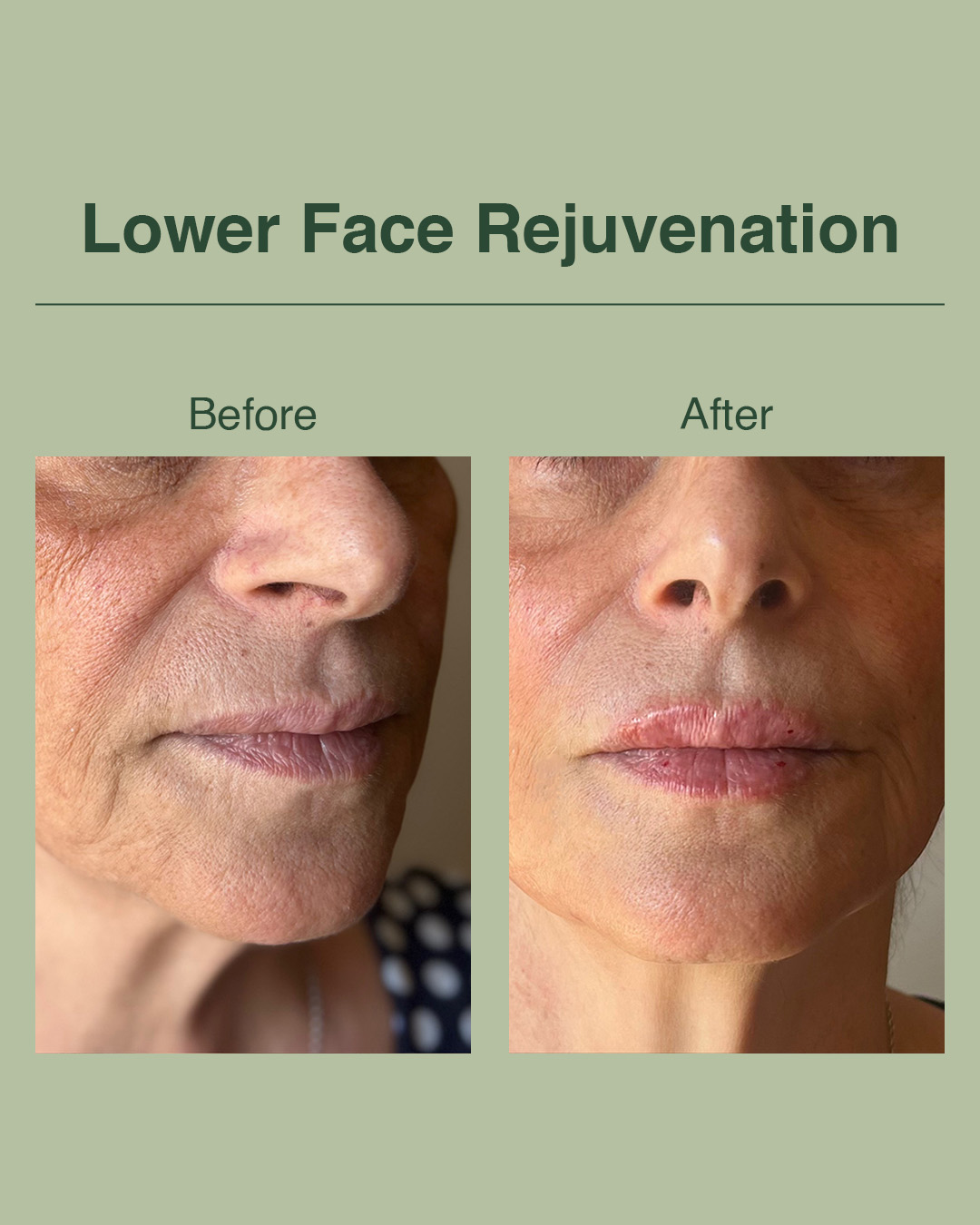 Sometimes all it takes is a little refresh ✨
Nothing dramatic, just softer lines and a more rested look. Still the same face, just feeling a bit more confident and glowing.
Natural results are always the goal 💉
#skincaretips #acnehelp #healthyskinjourney #skinfromwithin #clearskinhabits #skinawareness