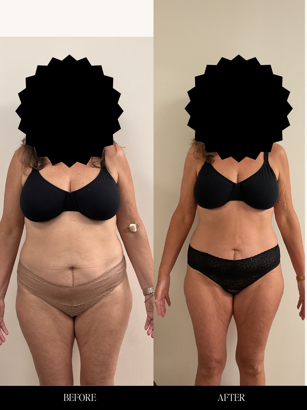 If you feel like you’ve tried everything and the weight still won’t budge… we hear you. 💕
Weight gain is not always about willpower. Hormones, metabolism, insulin resistance, inflammation, stress, and underlying health concerns can all play a role.
That’s why we start with comprehensive lab work to look deeper and understand what your body is trying to tell us.
This patient lost over 30 pounds with a personalized plan that included lifestyle changes and medically guided GLP-1 treatment — because real results start with treating the root cause, not just the symptoms. 👏
You do not have to keep fighting your body alone. There are answers, and there are options.
Ready to start your own transformation? Send us a message to schedule your consultation. 💕
📍Beauty Queens Aesthetics & Wellness Medicine
1776 Princess Anne Rd
Virginia Beach, VA 23456
☎️ 757-876-9136
🌐 www.beautyqueensvb.com
#WeightLossJourney #757 #GLP1WeightLoss #MedicalWeightLoss #BeforeAndAfter
WeightLossTransformation ComprehensiveLabs HormoneHealth HealthyLifestyle WellnessJourney ustainableWeightLoss BodyConfidence VirginiaBeachMedSpa