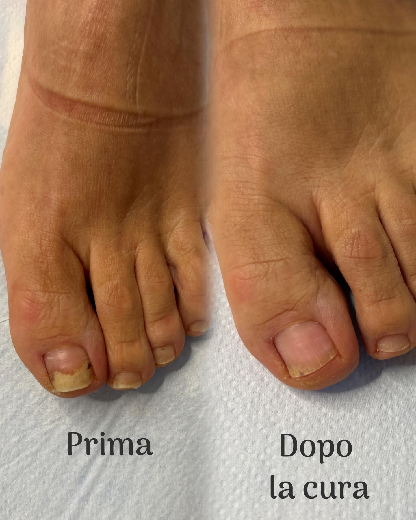 Con l’arrivo dell’estate, piedi in primo piano… ma attenzione alle infezioni ungueali 🦶☀️
Umidità, caldo, piscine e scarpe chiuse possono favorire la comparsa di micosi e altre infezioni delle unghie, spesso sottovalutate ma difficili da trattare se trascurate.
Come prevenirle?
✔️ Asciuga sempre bene i piedi, soprattutto tra le dita
✔️ Usa ciabatte in ambienti condivisi (piscine, palestre)
✔️ Scegli calzature traspiranti
✔️ Non condividere strumenti per la cura delle unghie
Se noti unghie ispessite, ingiallite, fragili o che si sfaldano, non aspettare rivolgiti ad un dermatologo.
#onicomicosi #nailcare #curadeipiedi
