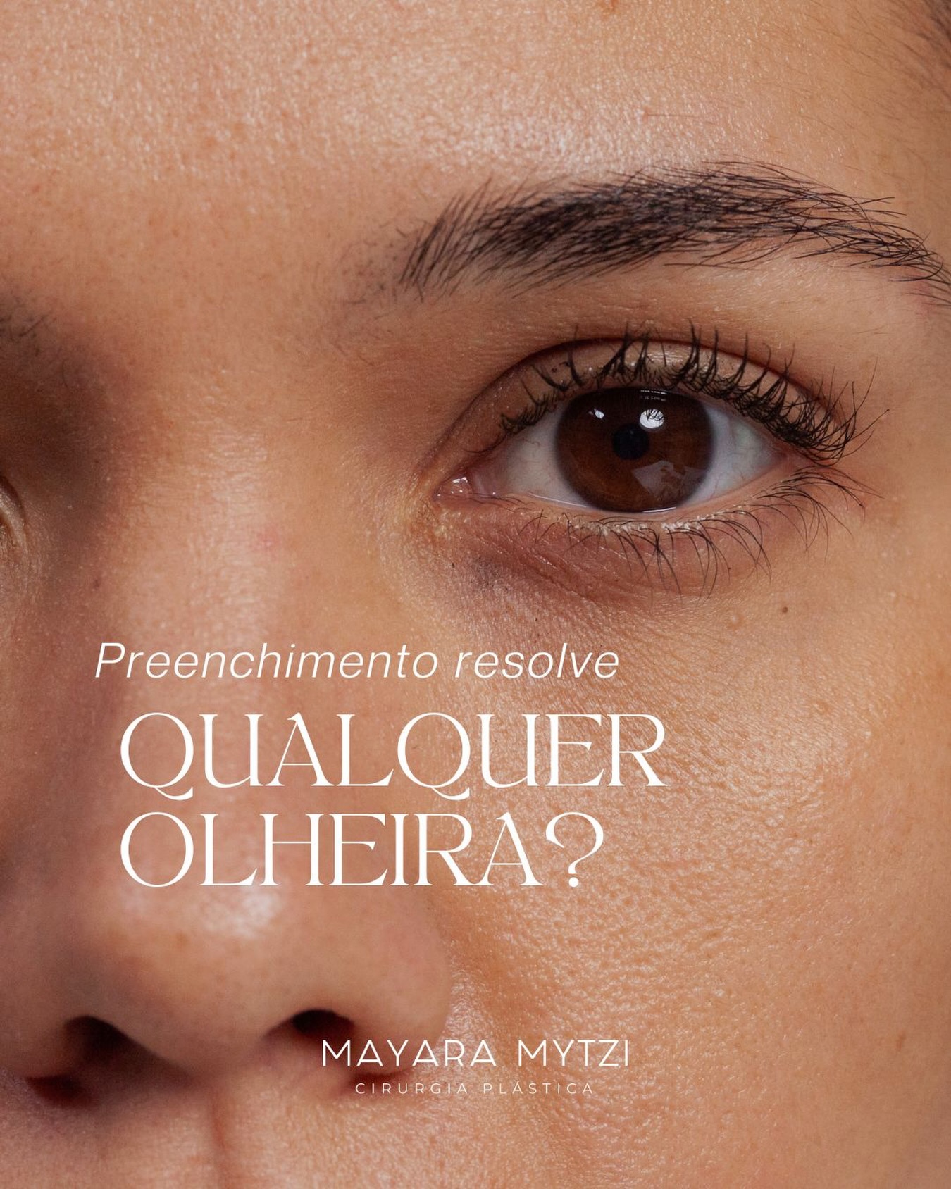 O preenchimento pode ajudar no tratamento das olheiras, mas não é indicado para todos os casos.
As olheiras podem ter diferentes causas, como sulco profundo, pigmentação, fatores vasculares ou bolsas de gordura. Por isso, cada situação exige uma abordagem específica.
Em muitos casos, associamos técnicas para alcançar um resultado mais natural e equilibrado.
Você quer saber qual é a principal causa da sua olheira? Agende uma consulta!
Dra. Mayara Mytzi
CRM SP 136.044 • Médica
Cirurgiã Plástica • RQE 66881
#dramayaramytzi
#cirurgiaplastica